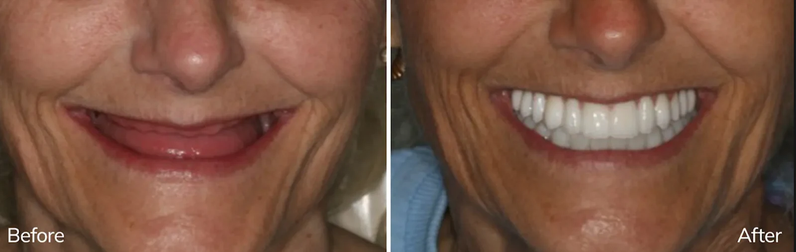 Before and After Dental Implant Treatment