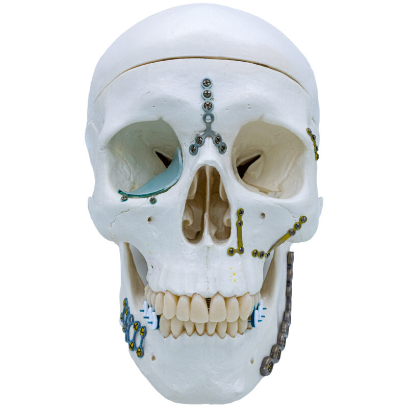 facial trauma repair skeleton model