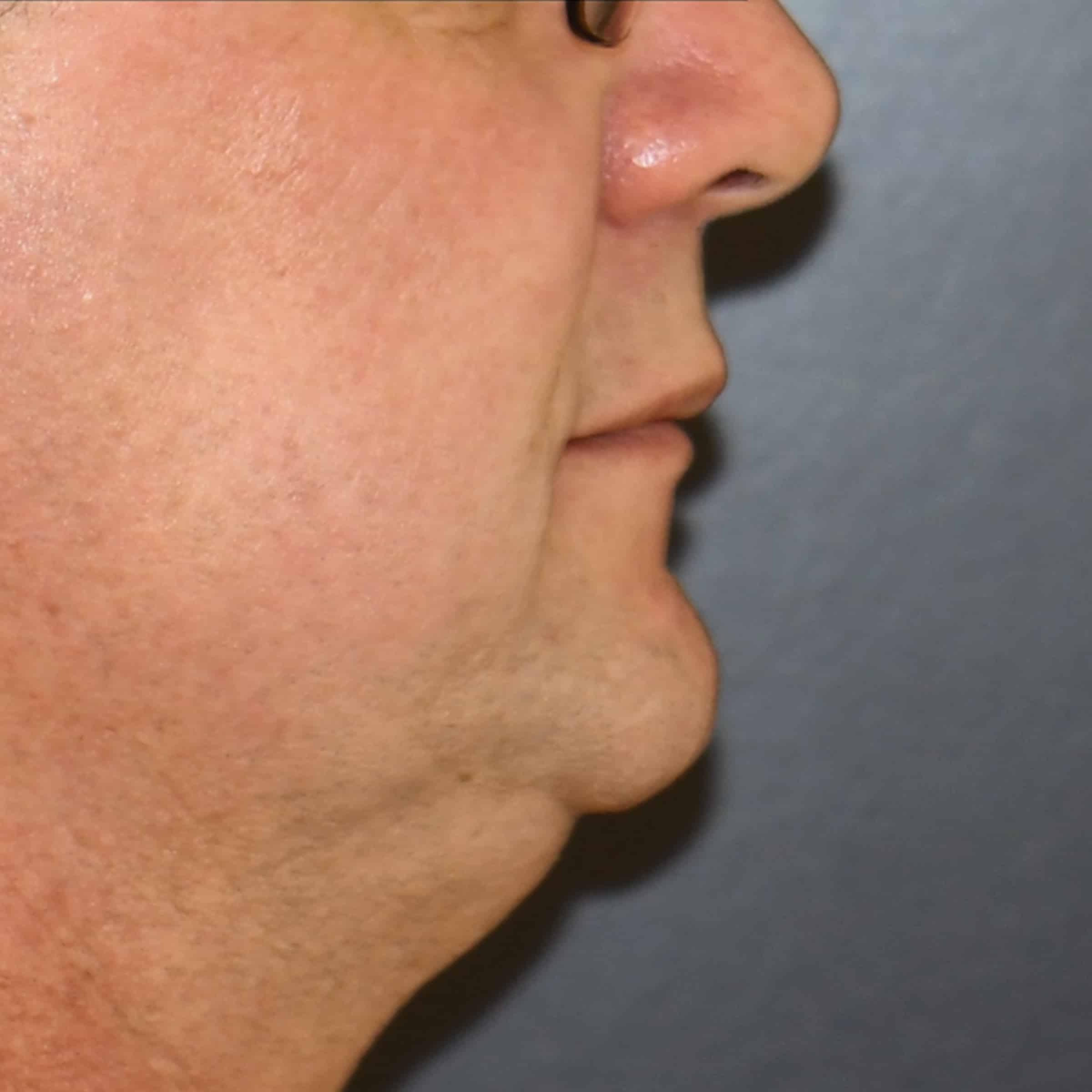 Close-up profile of a person's facial features against a plain, dark background. The person is wearing glasses visible on the side.