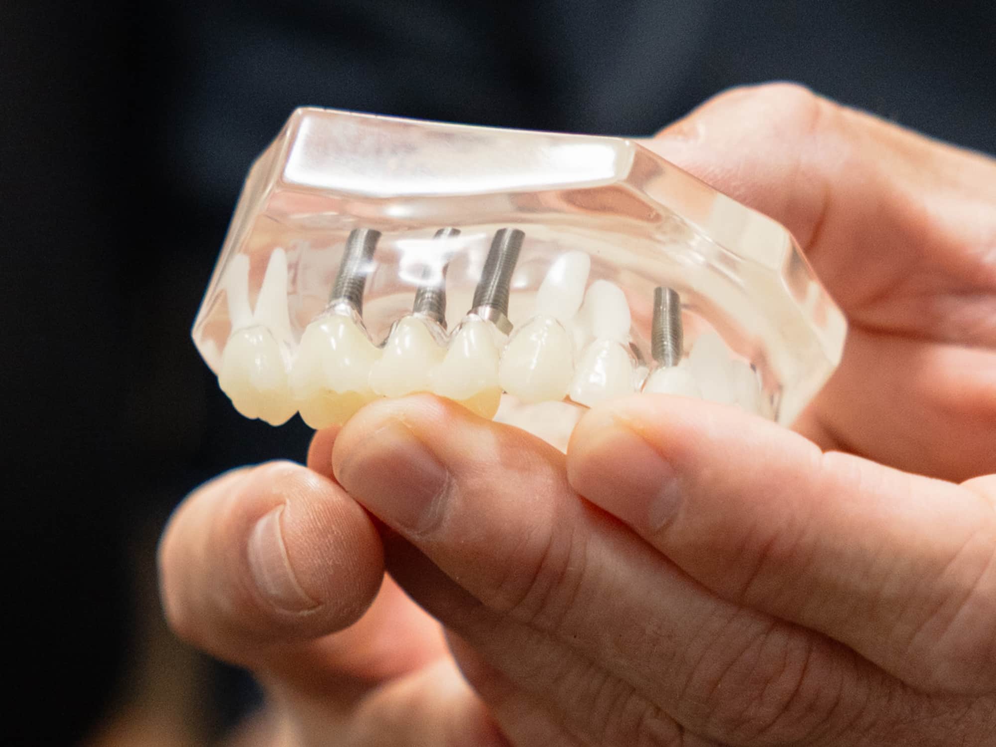 A person holds a dental model showcasing implanted teeth, with visible tooth implants and realistic acrylic gums, demonstrating dental restoration techniques.