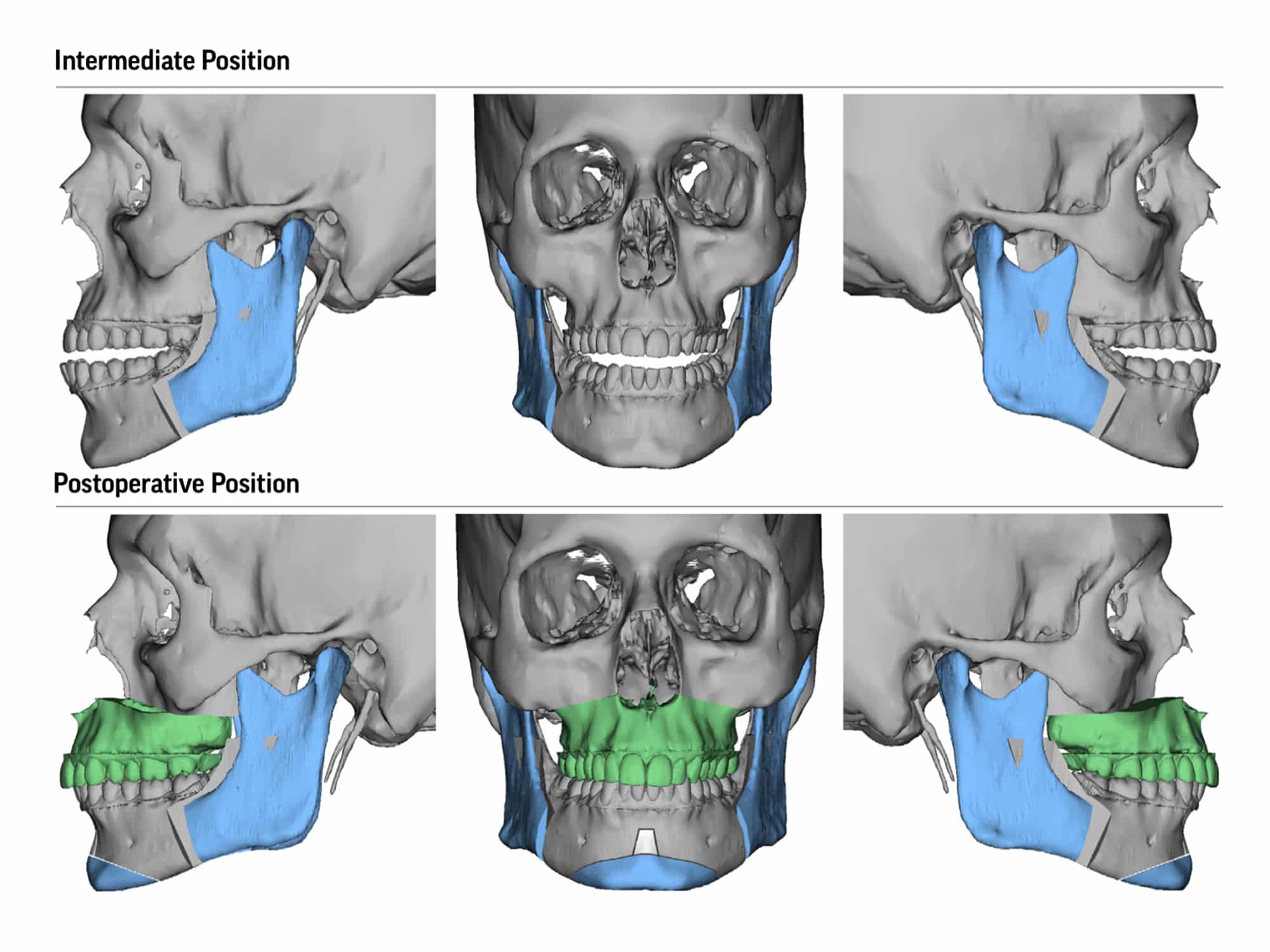 Medical diagrams illustrating jaw surgery, showing intermediate and postoperative positions. Color-coded areas highlight surgical changes. Three views presented per position.
