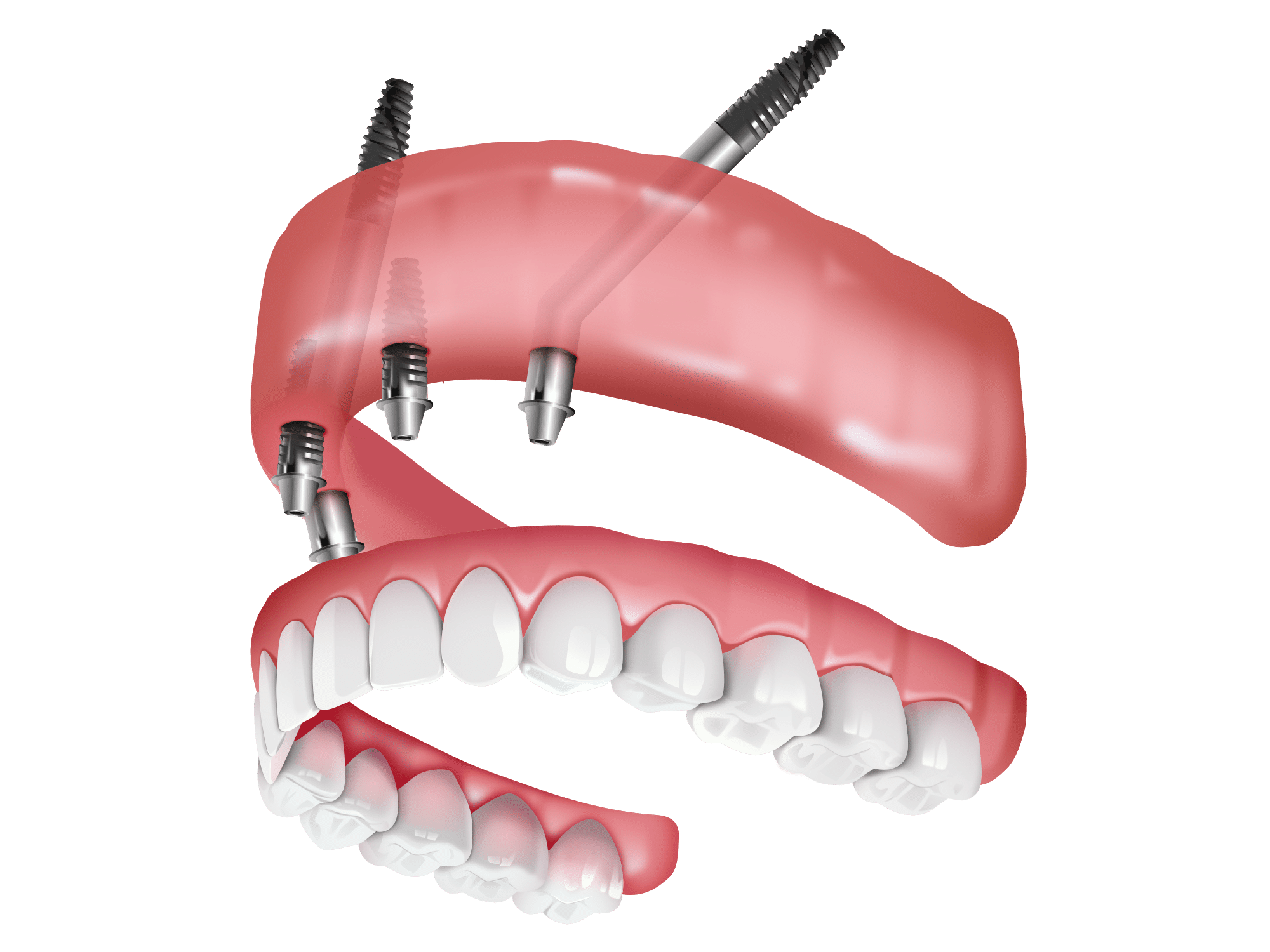 Illustration showing two sets of dental implants with attached dentures, featuring detailed views of the gum structure and implant screws.