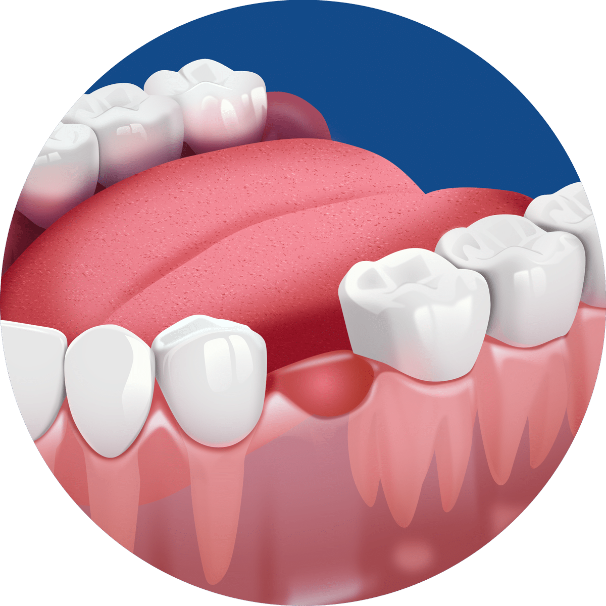 An illustration of human gums, showing teeth and an exposed socket, with the tongue visible in a circular frame on a blue background.