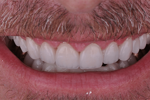 Close-up of a person's smile with well-aligned teeth, light facial hair, and healthy gums. No landmarks or historical buildings visible.