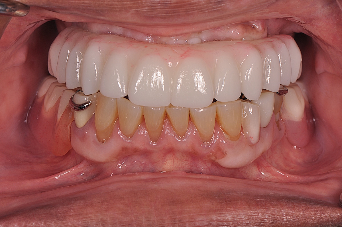 Close-up of a dental model showing both upper dentures and lower natural teeth with visible metal clasps on the side.