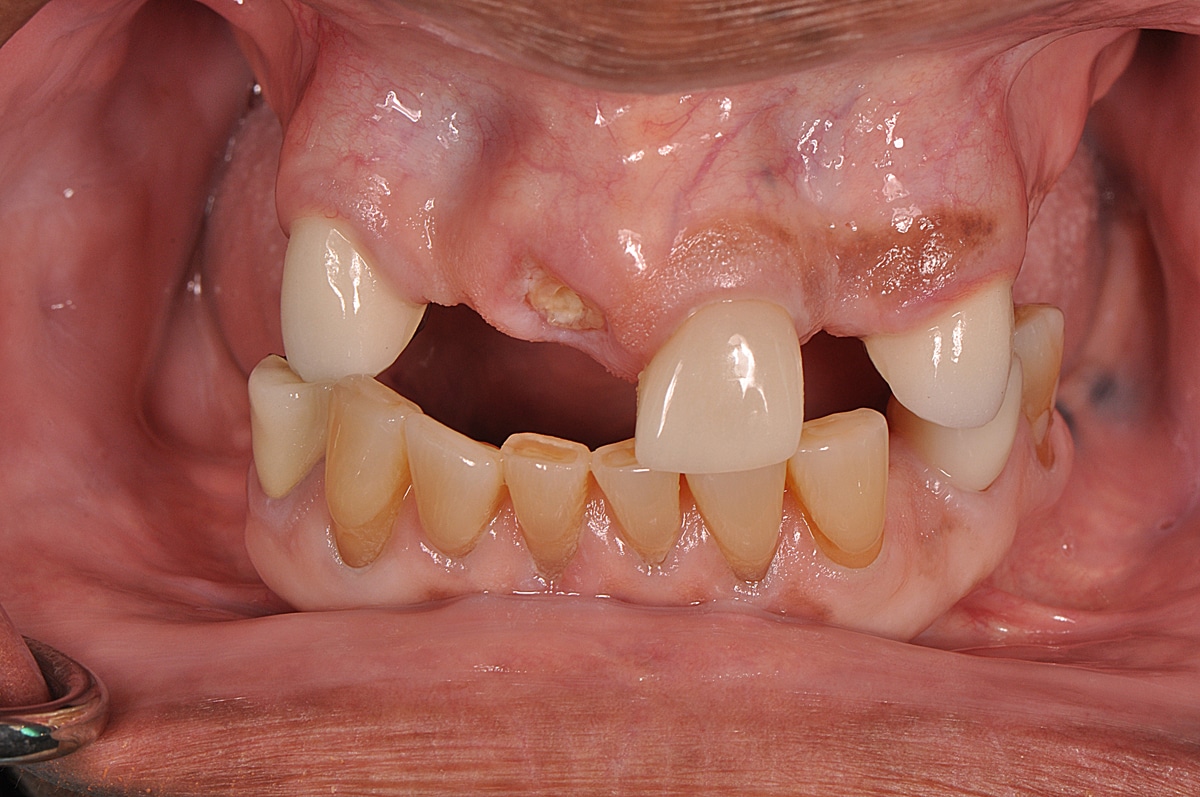 Close-up of a person's dental condition showing missing teeth, worn down edges, and gum recession, indicating dental health issues needing attention.