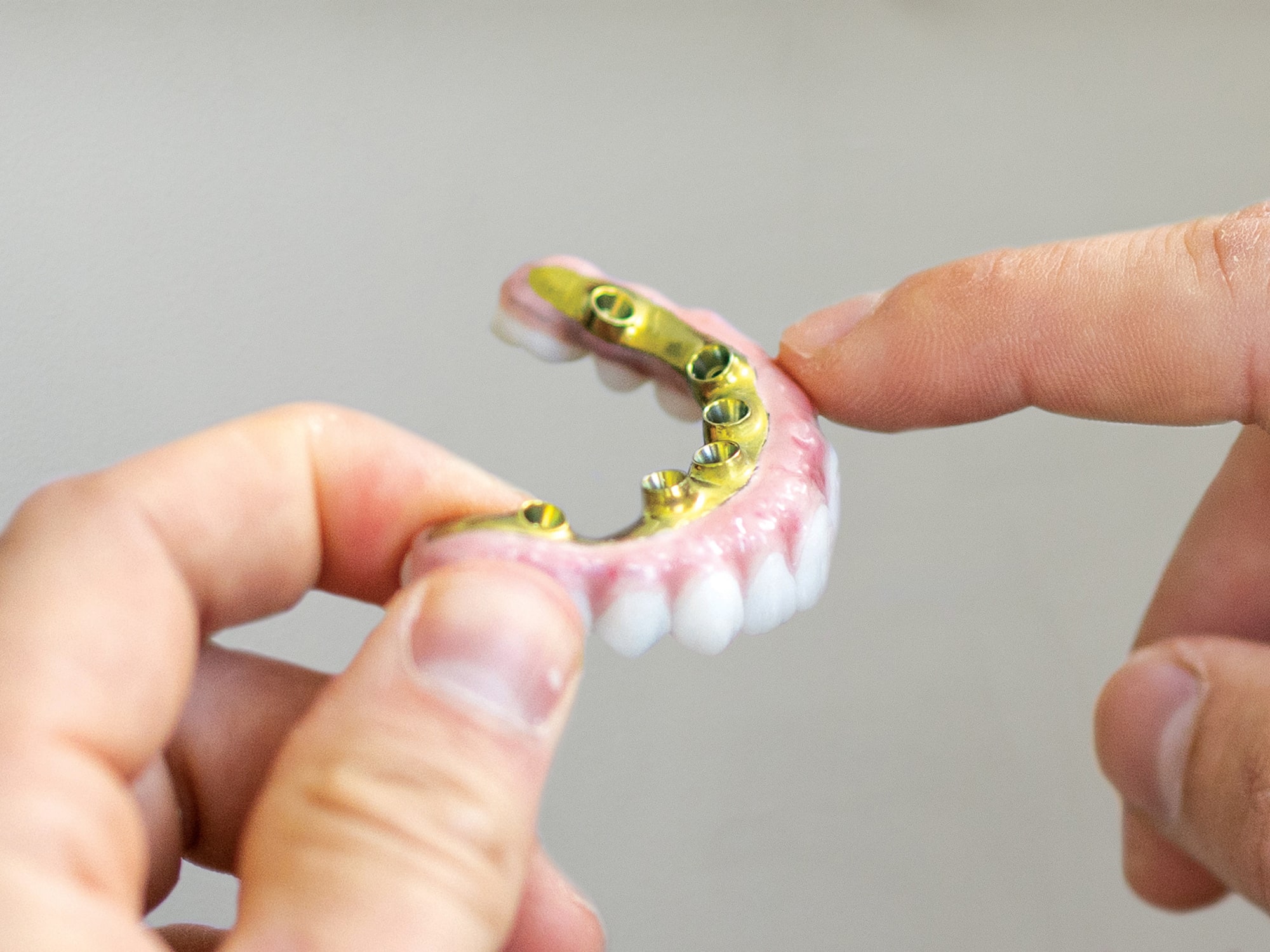 A person holds a dental prosthesis with metal implants, examining the structure closely against a plain background, showcasing dental technology.