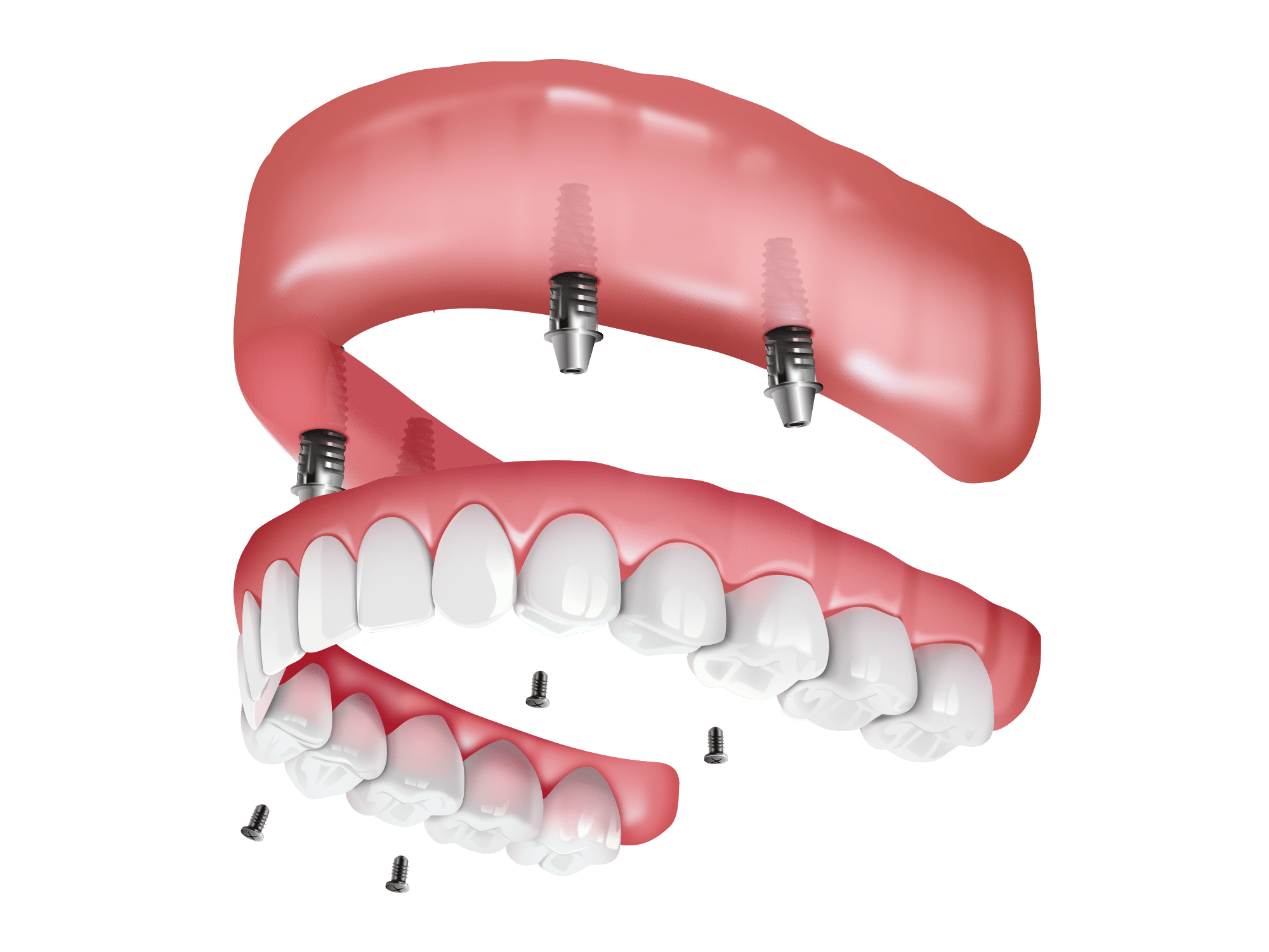 Illustration showing dental implants and artificial teeth in an upper jaw. Implants are embedded into the gum, supporting a full set of dentures.
