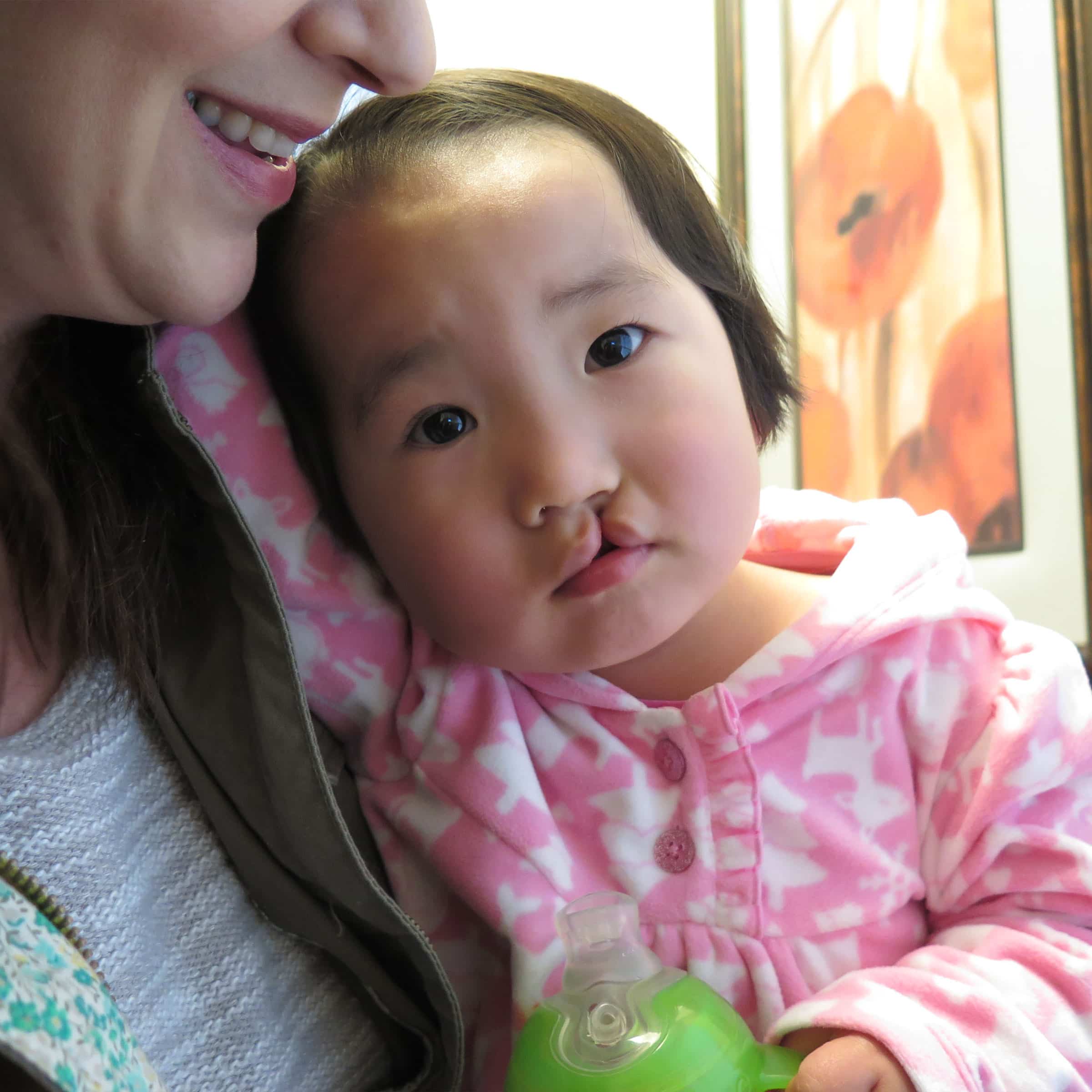 A person smiling beside a baby with a cleft lip, wearing a pink outfit, holding a green sippy cup, with floral artwork behind.