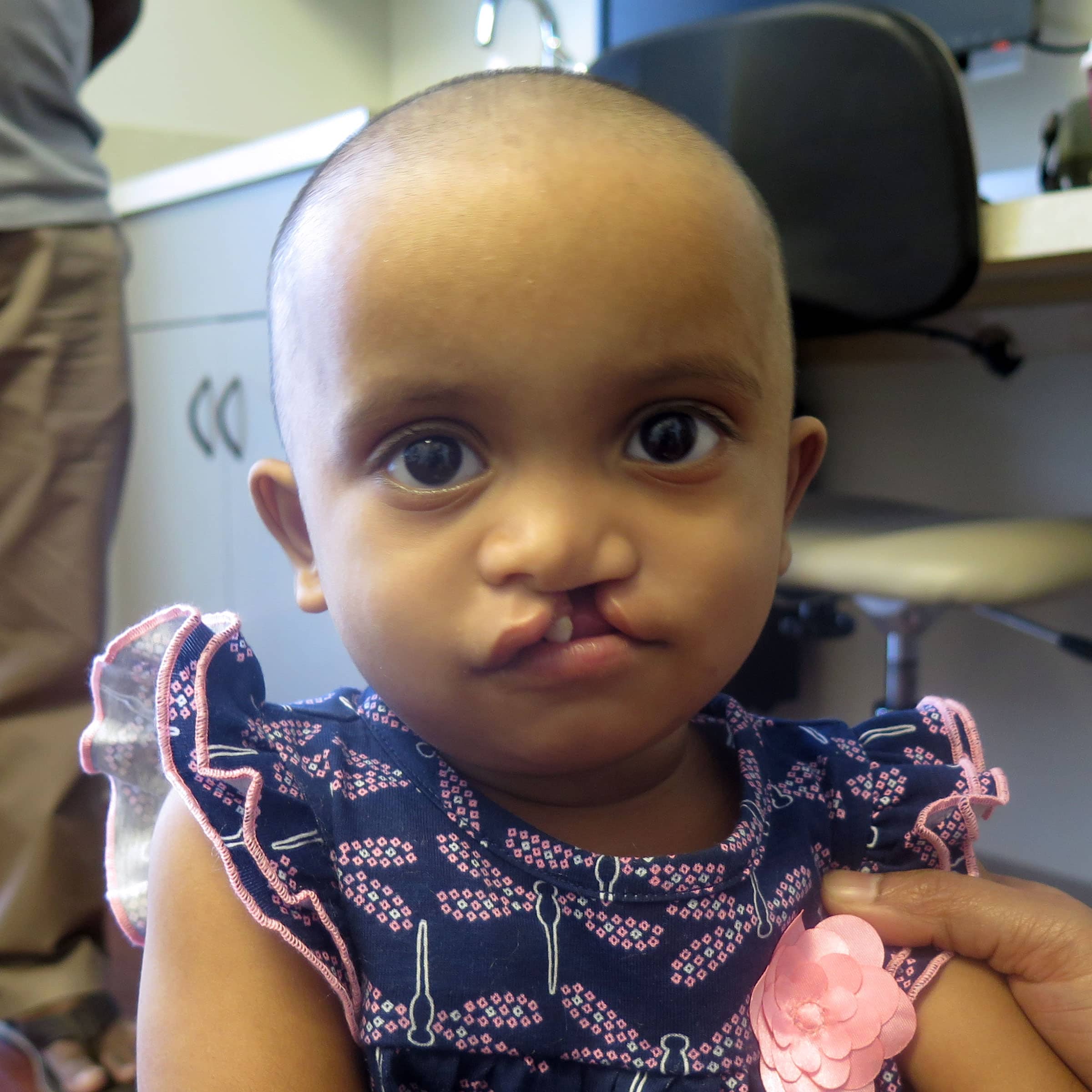 A baby with a cleft lip, wearing a patterned shirt, is being gently held in what appears to be a medical office.