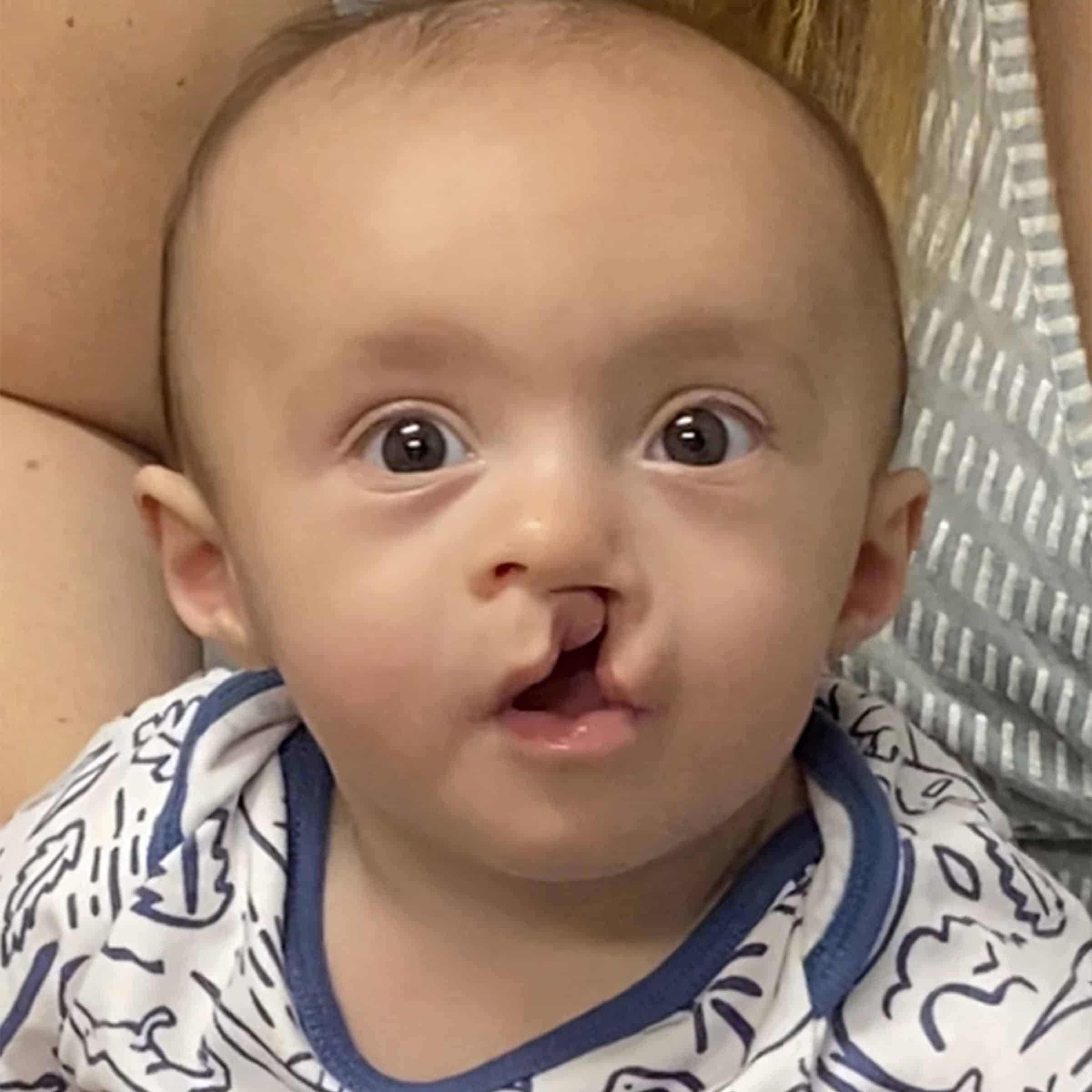 A baby with a cleft lip wearing a patterned onesie sits on a person's lap, looking up with wide eyes and a curious expression.