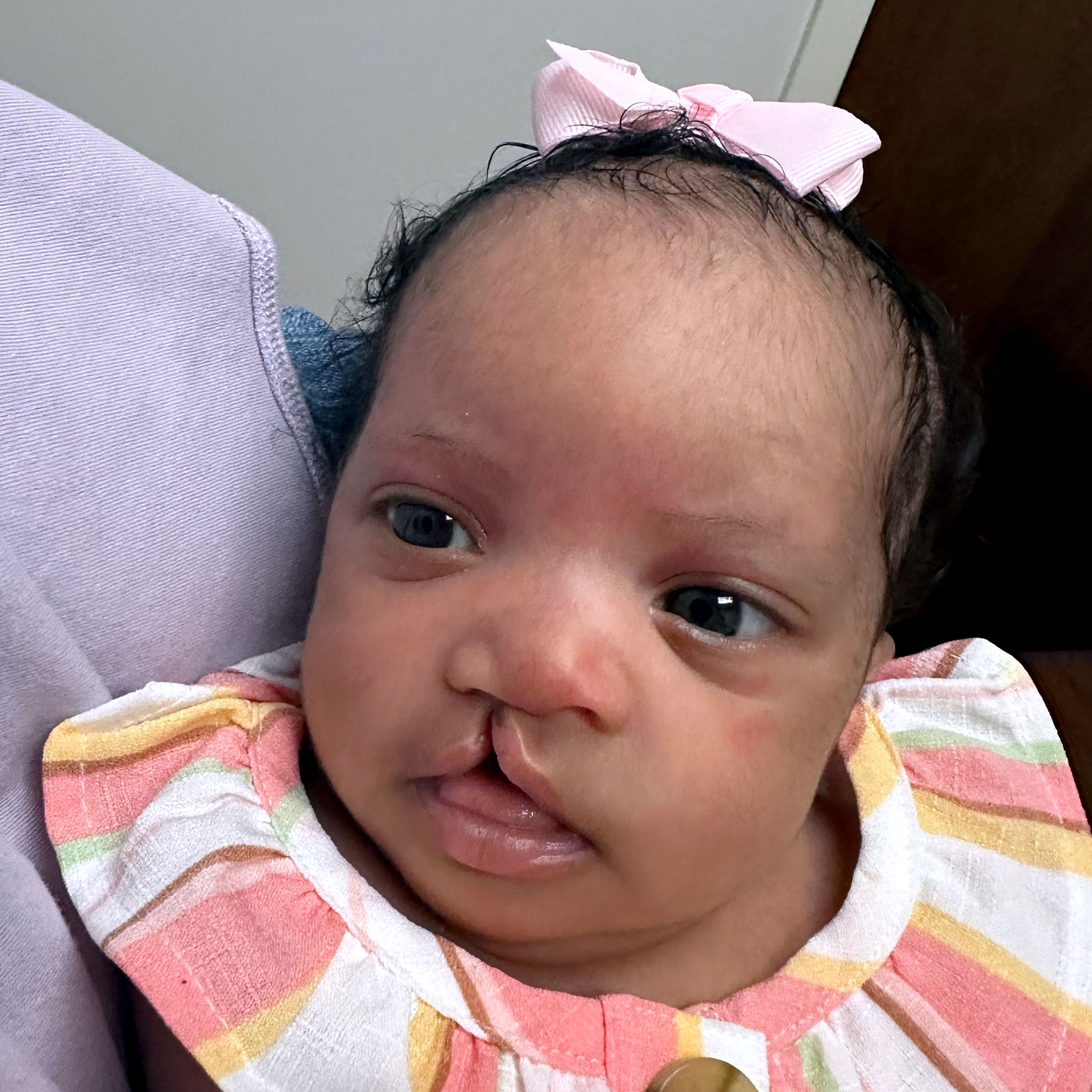 Cleft & Craniofacial Patient Transformation - Before