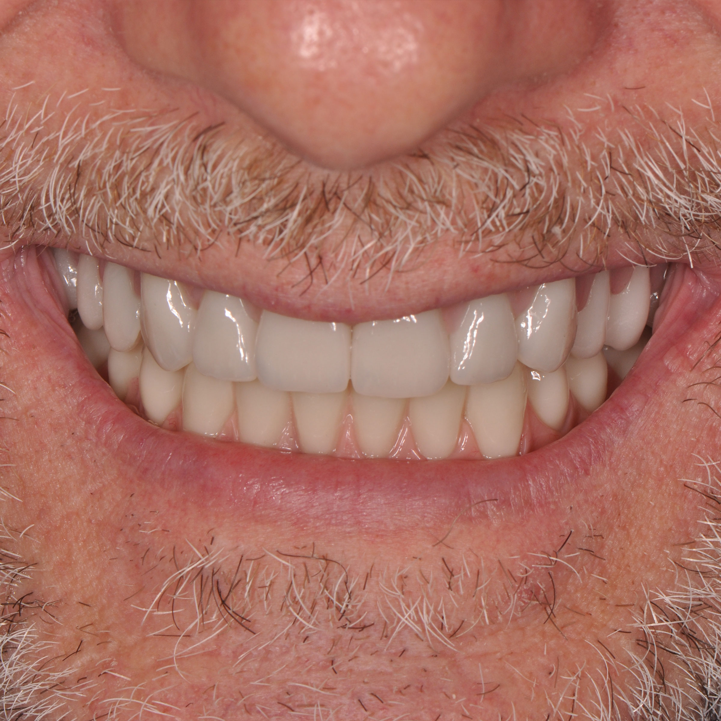 Full mouth dental implants transformation - before