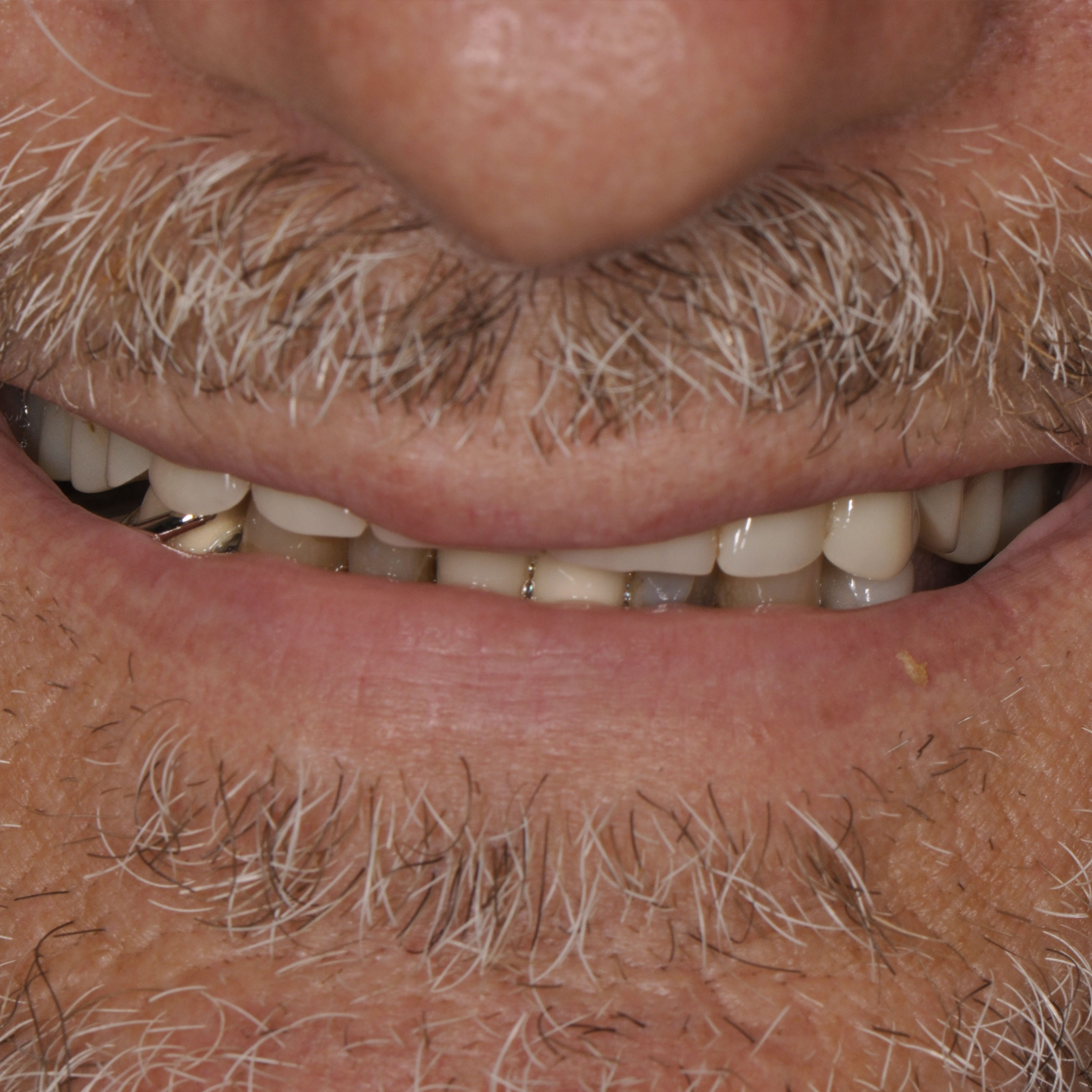 Full mouth dental implants transformation - after
