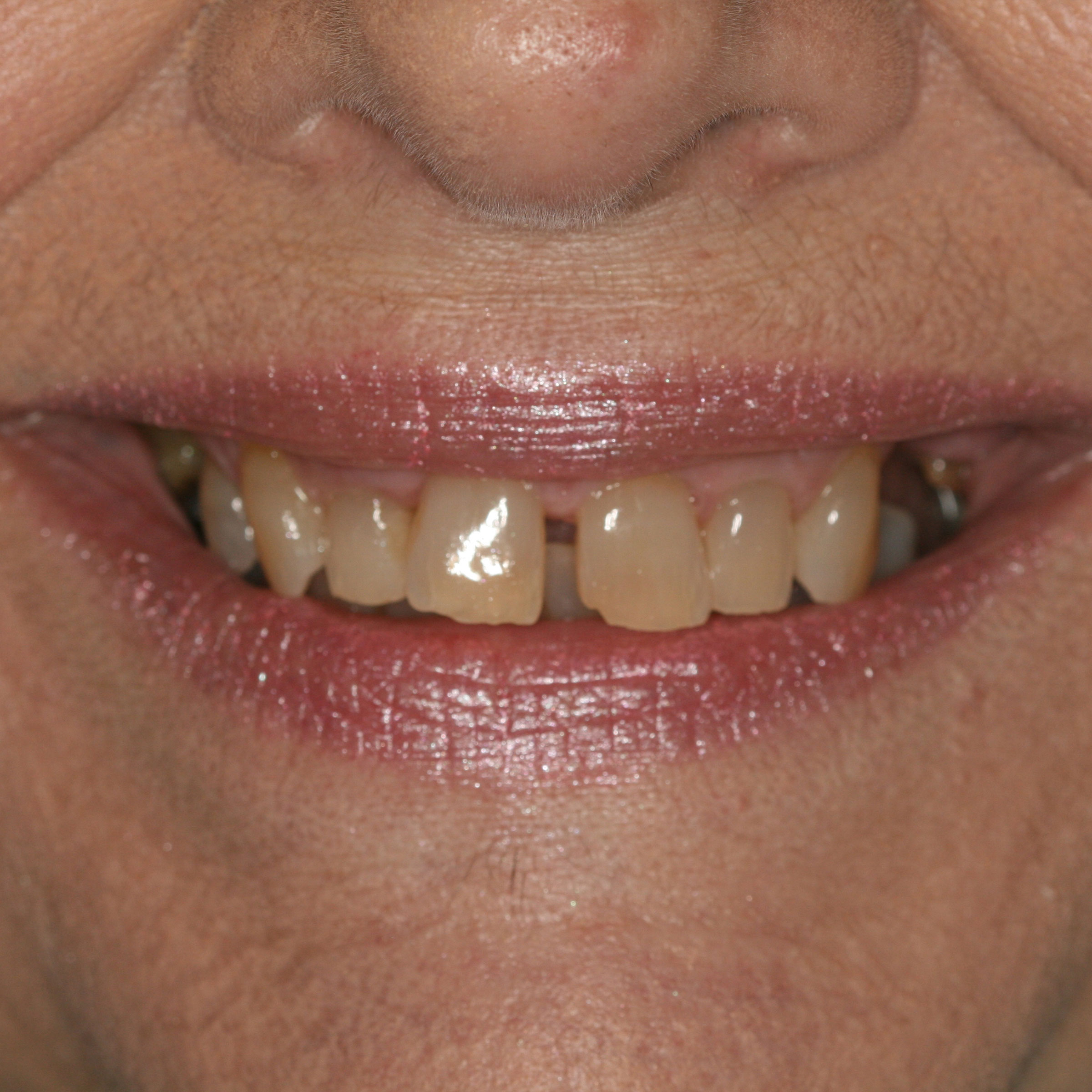 Full mouth dental implants transformation - before