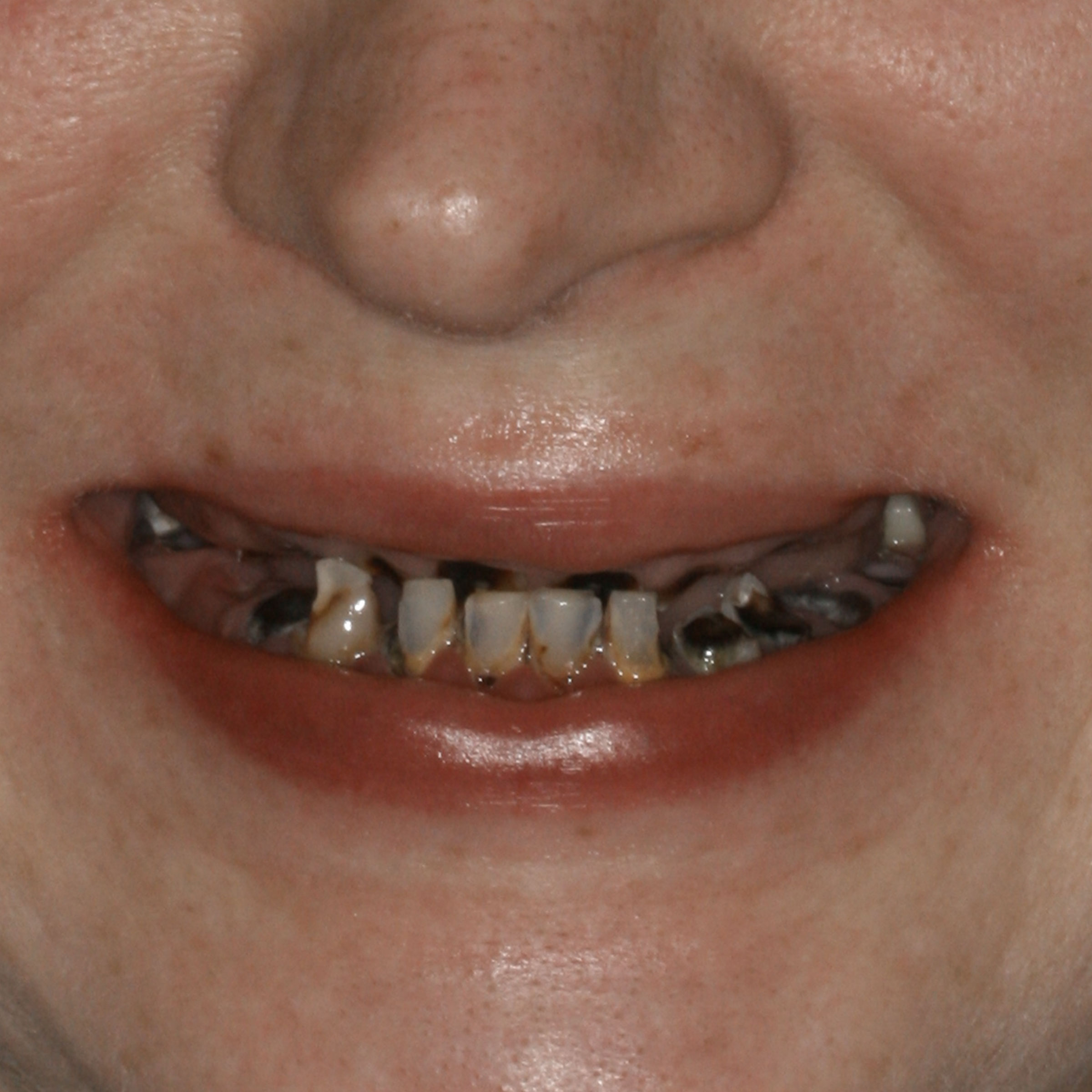 Full mouth dental implants transformation - before