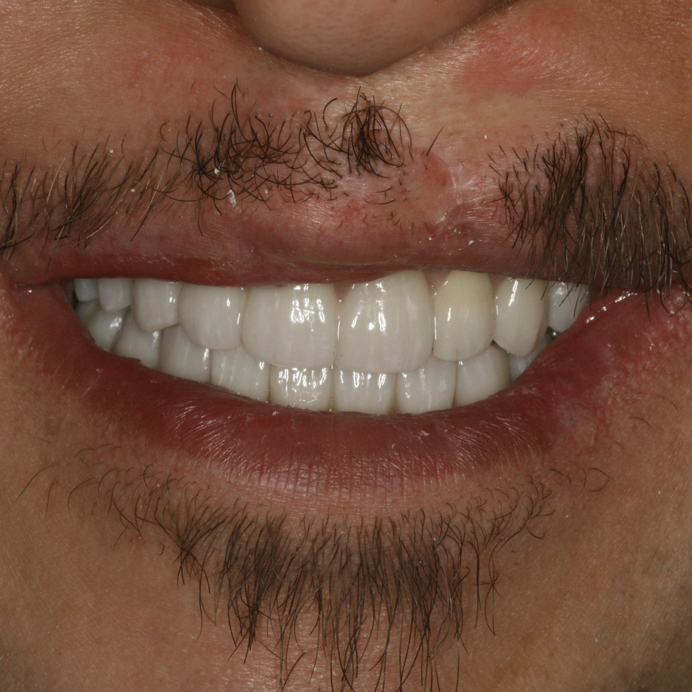 Full mouth dental implants transformation - after