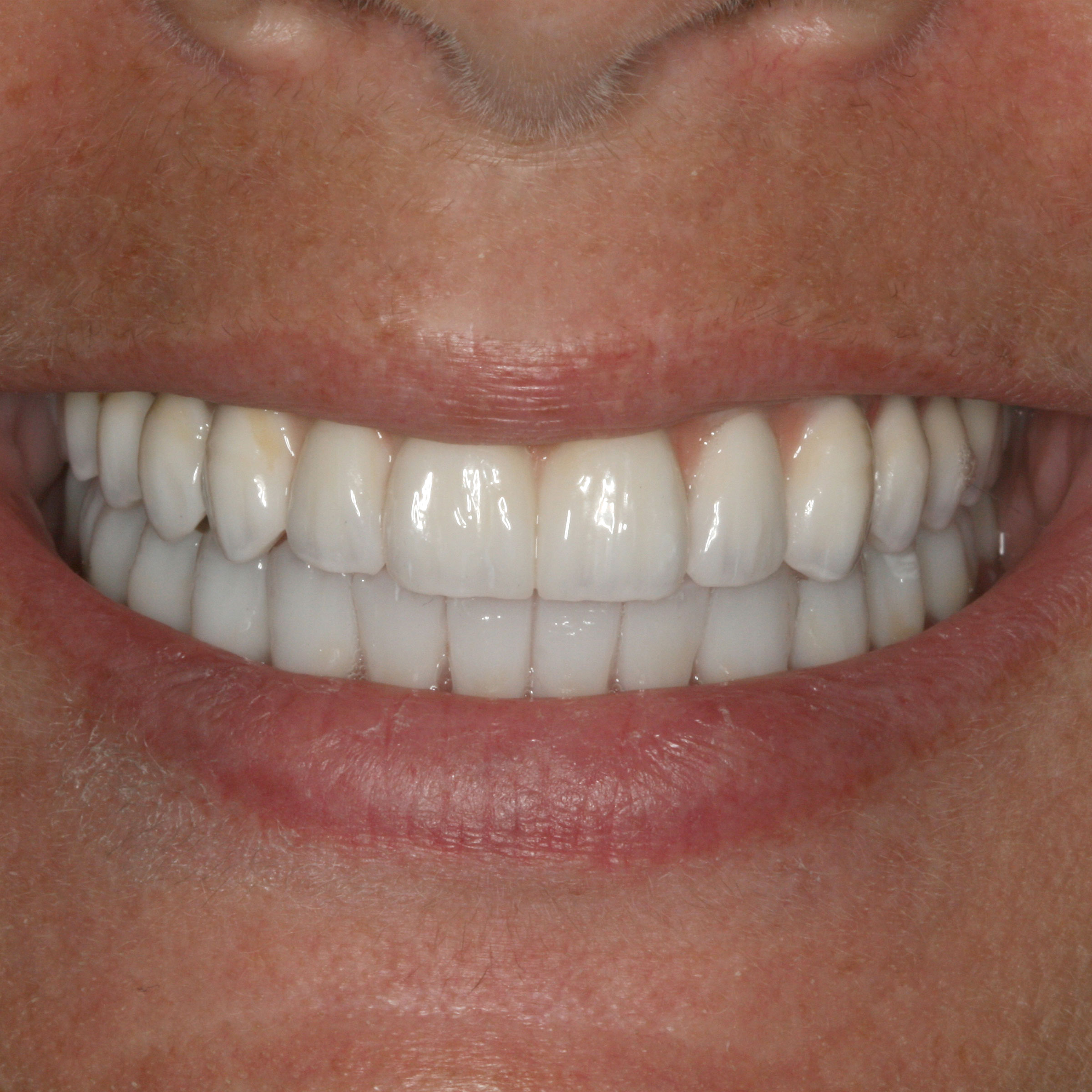 Full mouth dental implants transformation - after