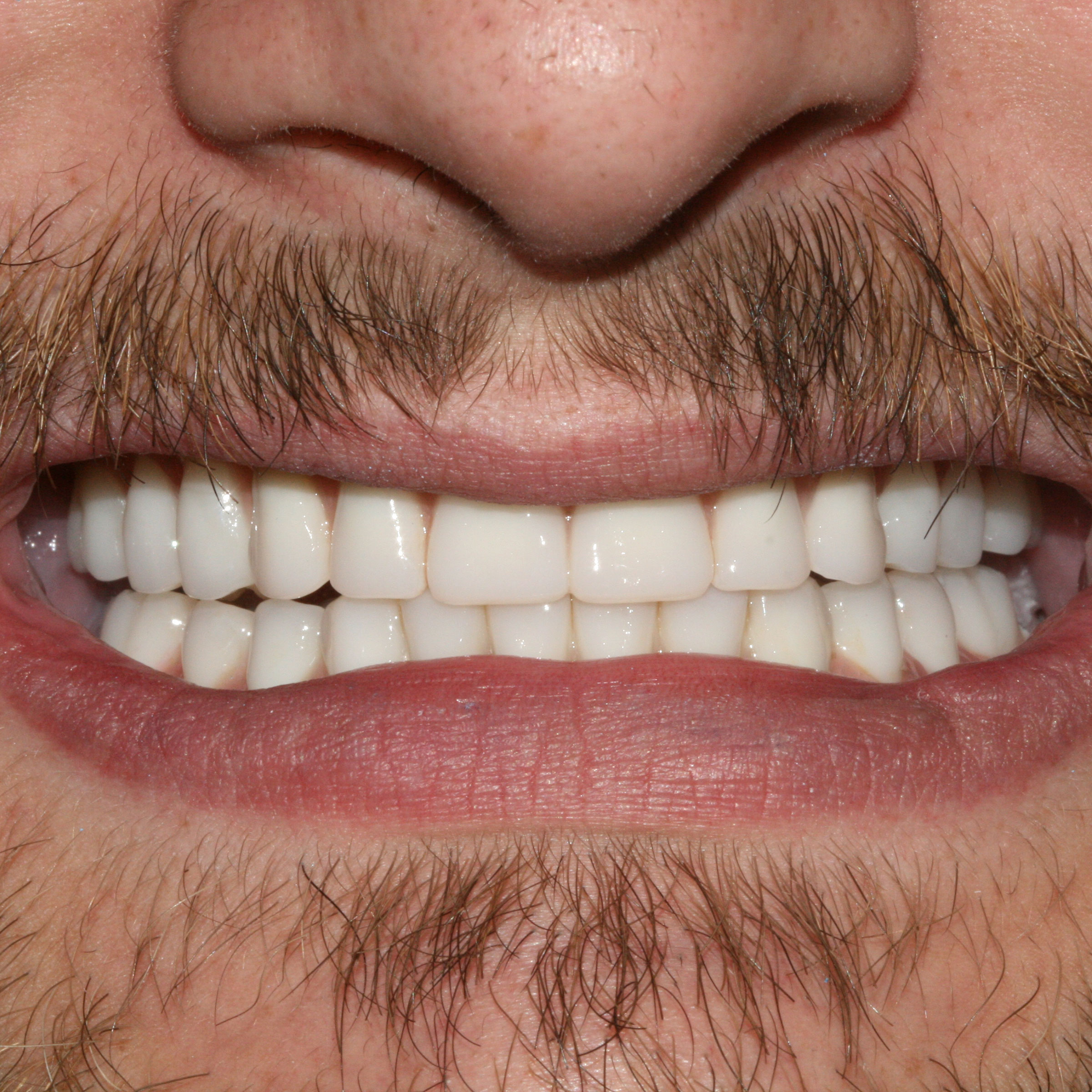 Full mouth dental implants transformation - after