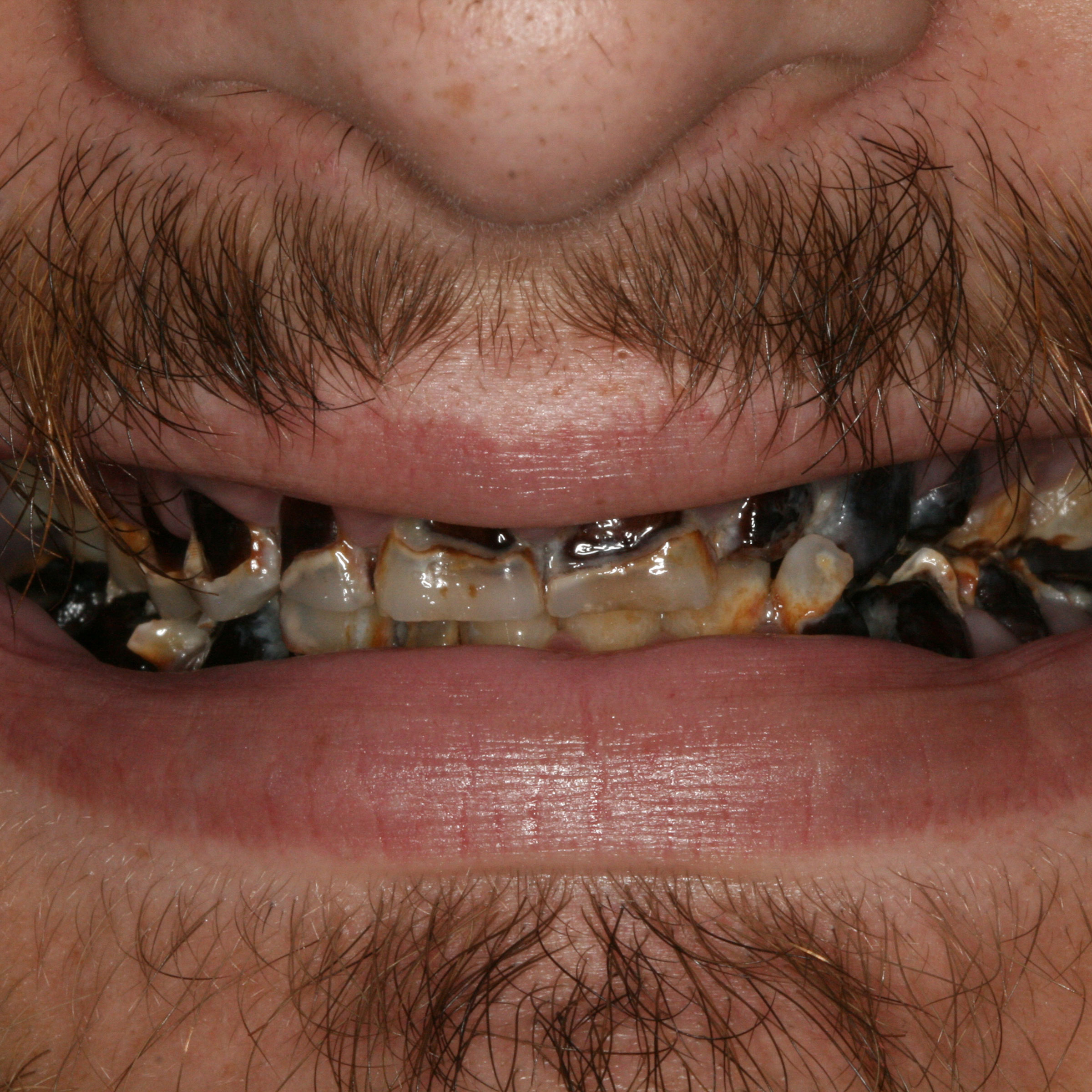 Full mouth dental implants transformation - before