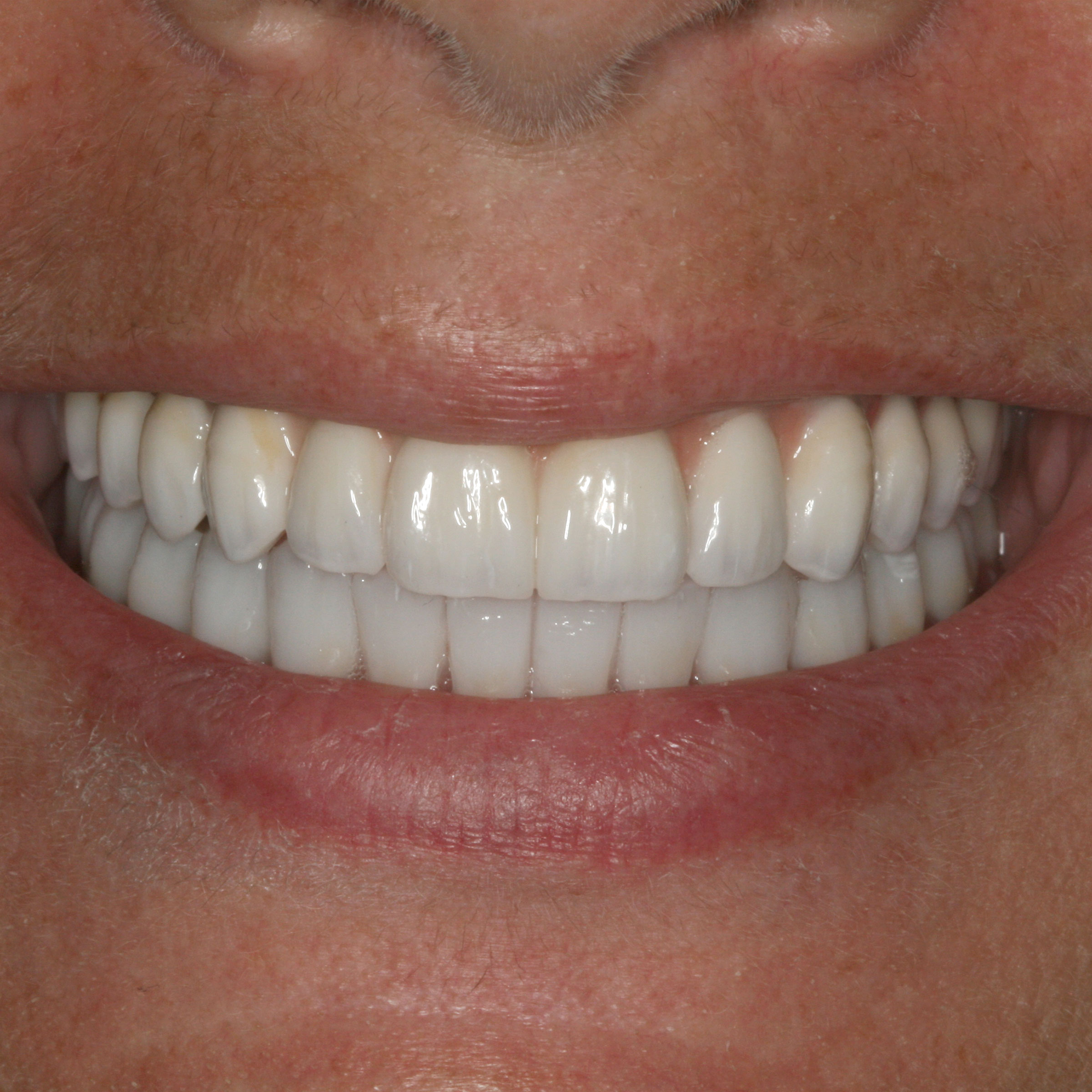 Full mouth dental implants transformation - after