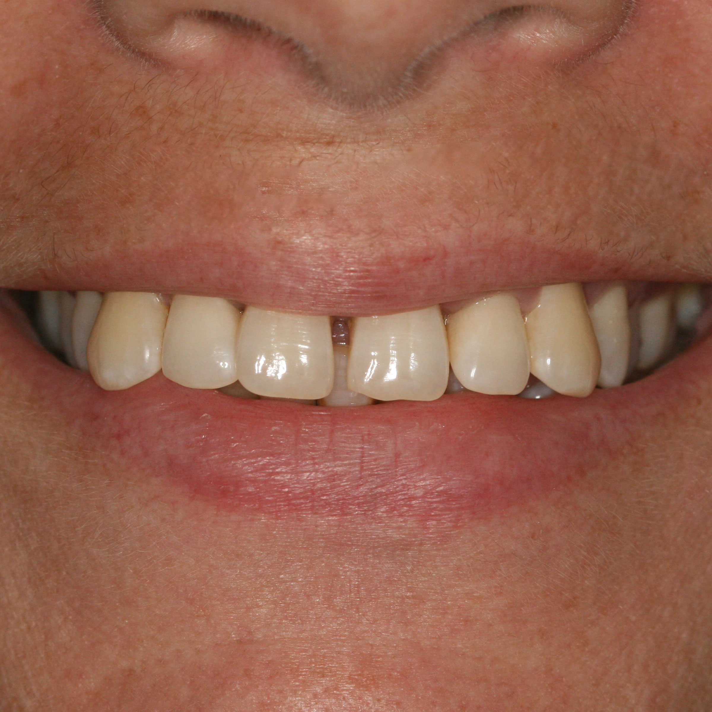 Full mouth dental implants transformation - before