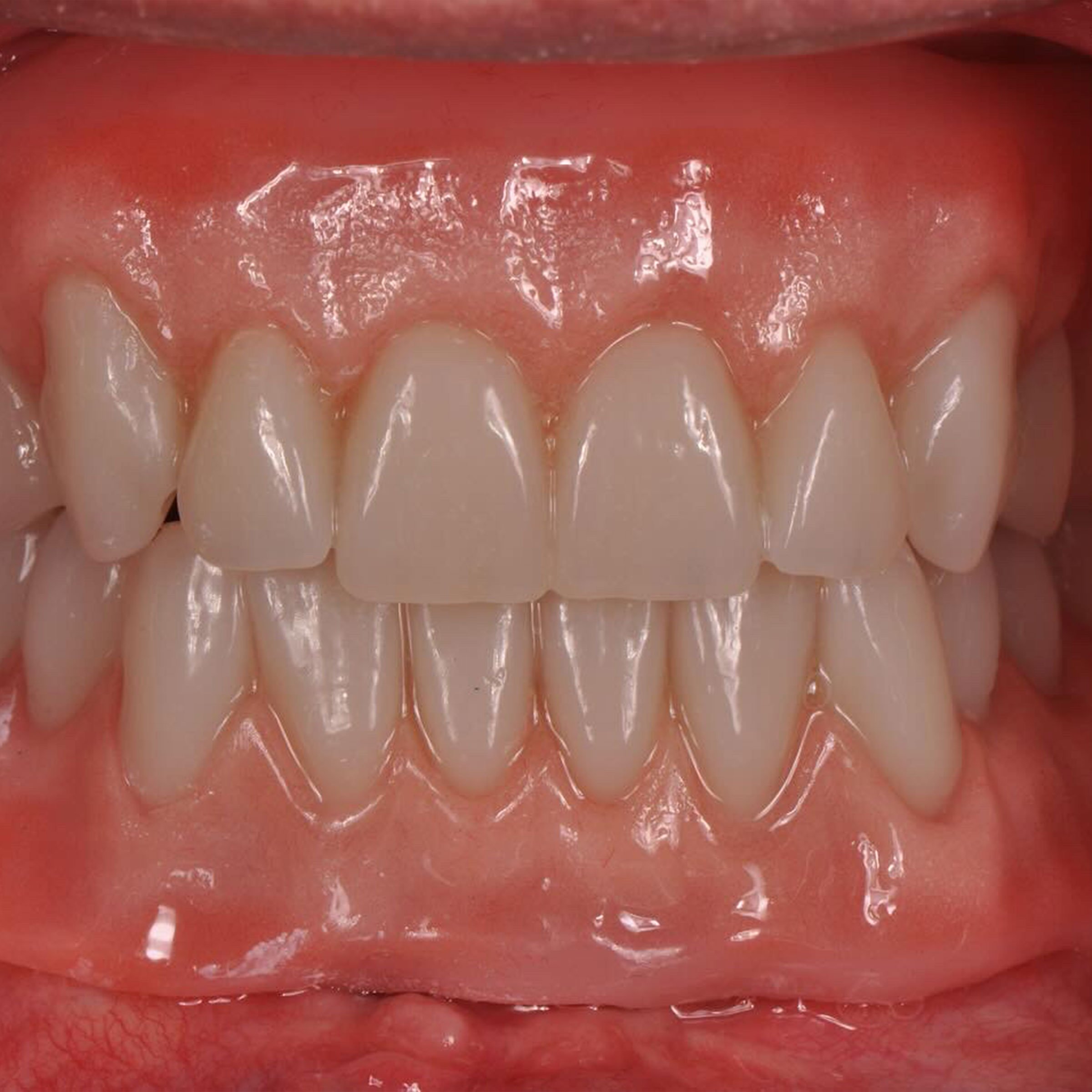 Full mouth dental implants transformation - after