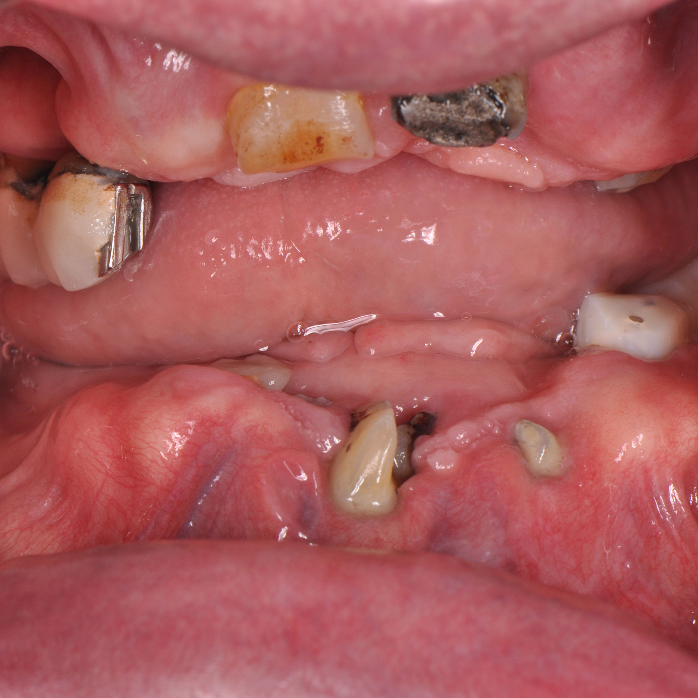 Full mouth dental implants transformation - before