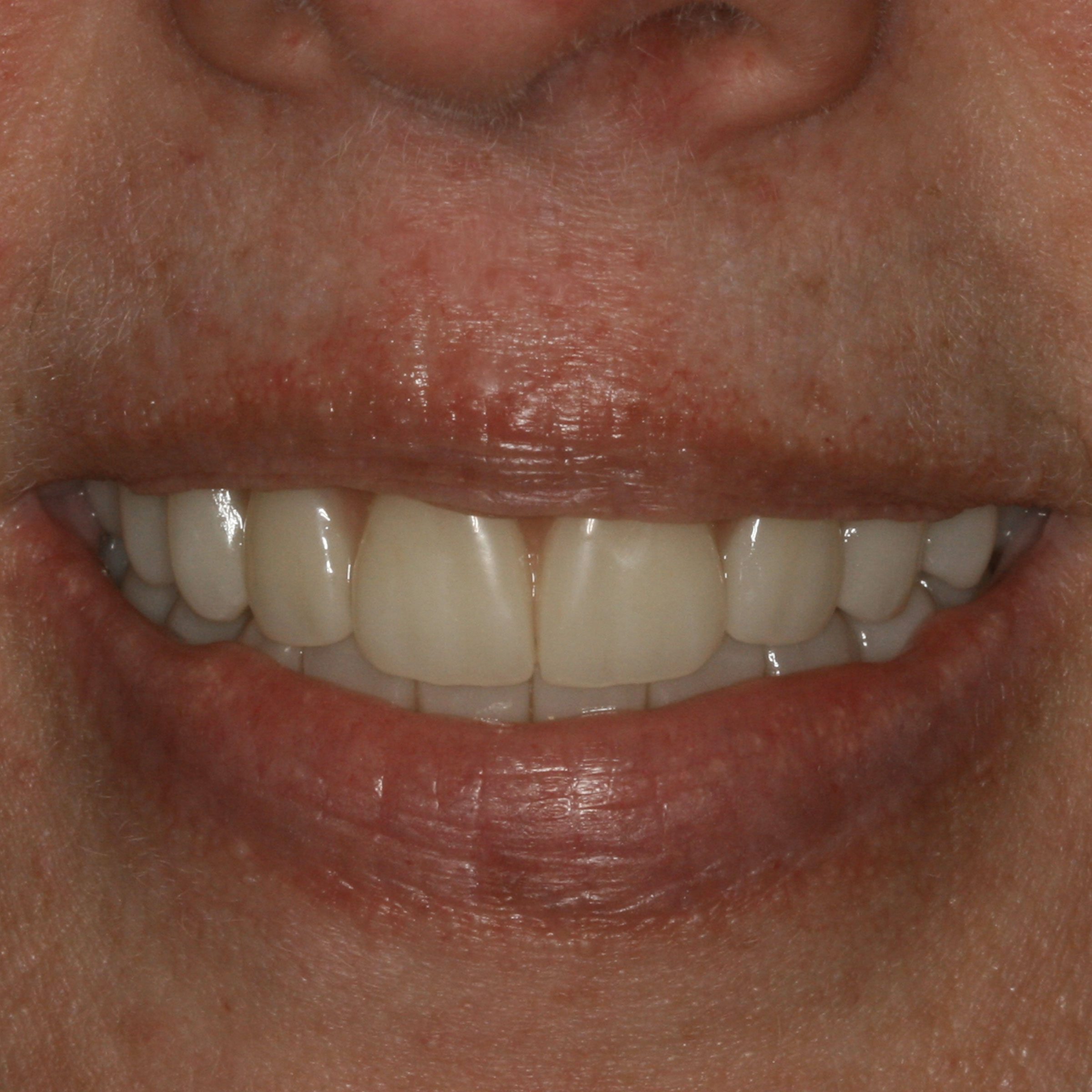 Full mouth dental implants transformation - after