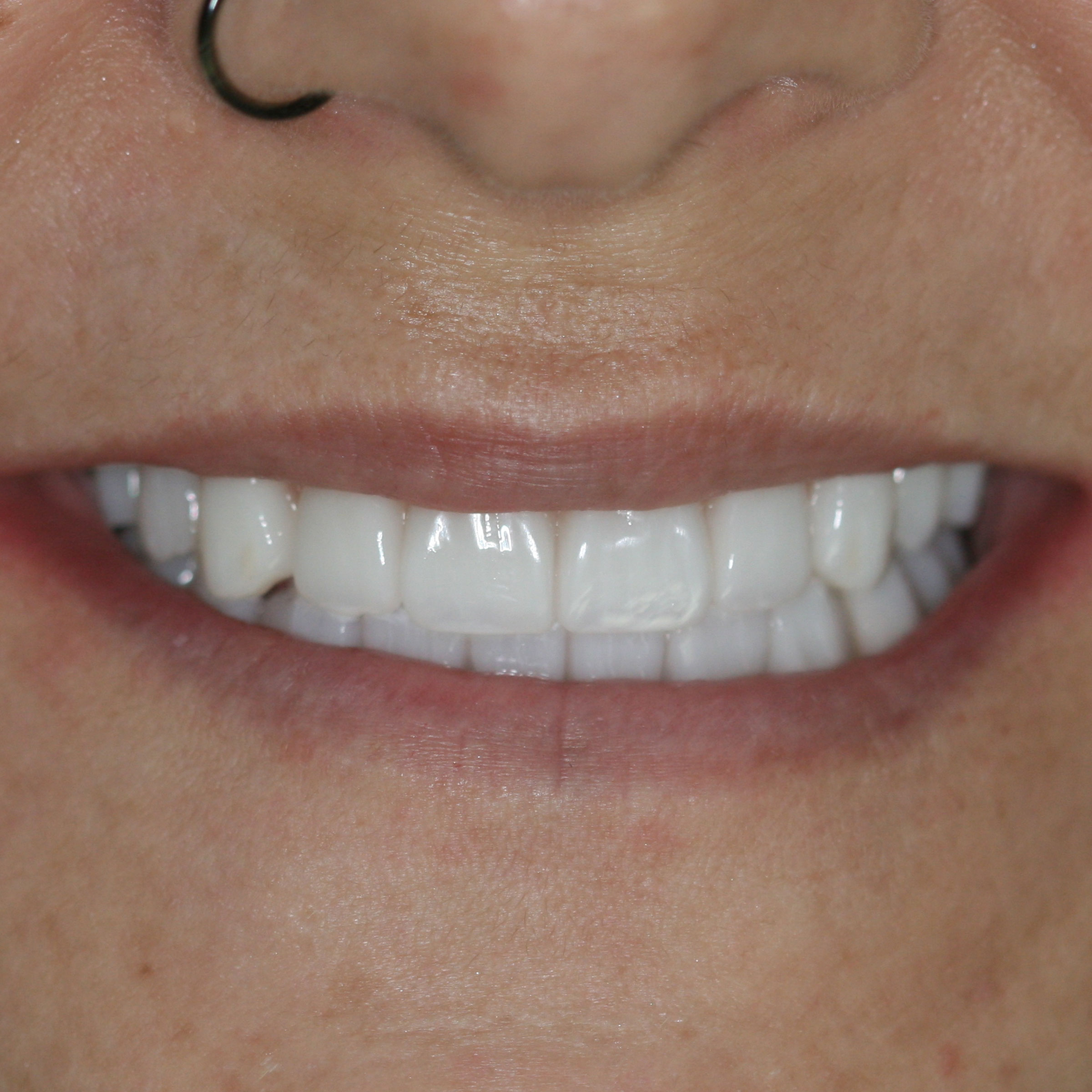 Full mouth dental implants transformation - after