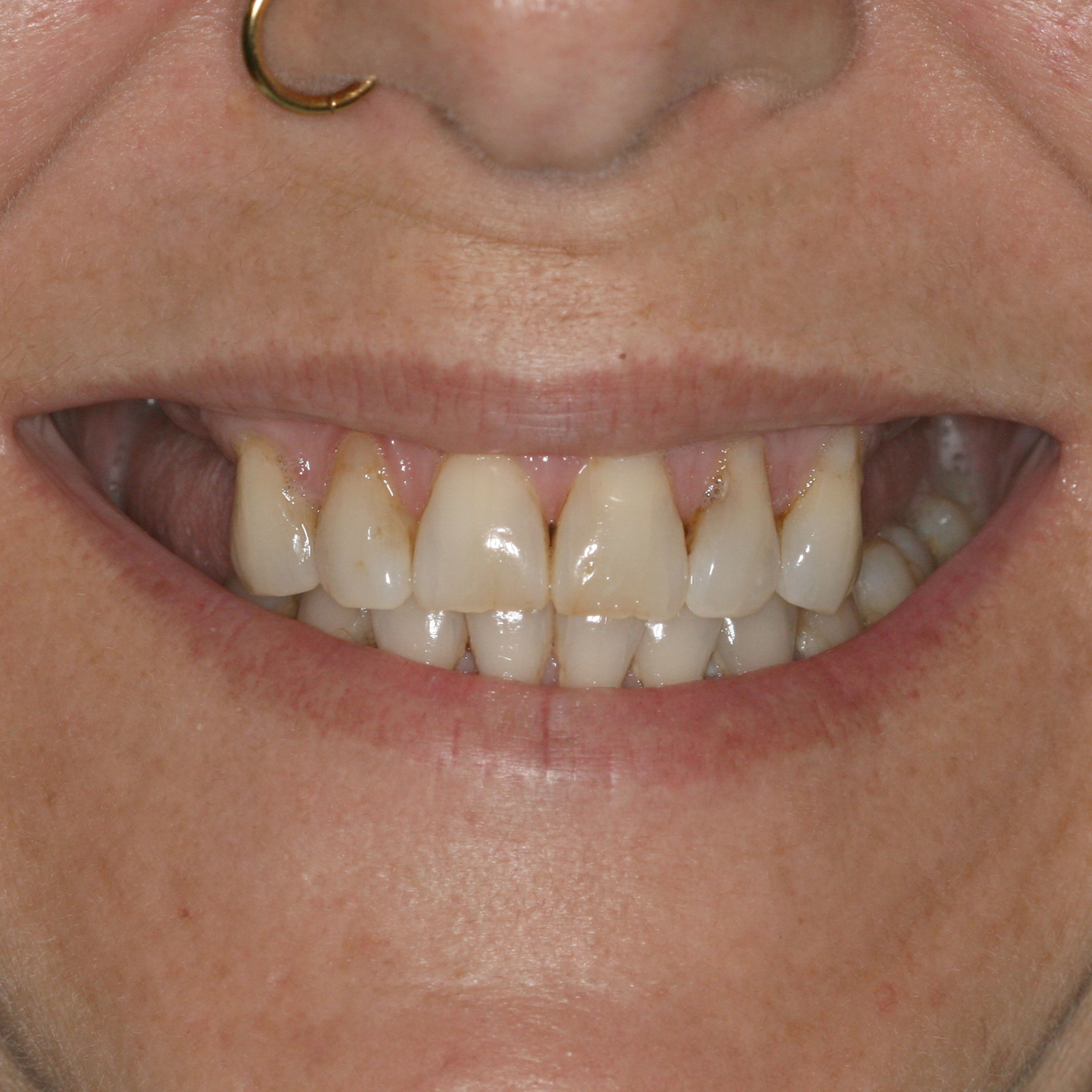 Full mouth dental implants transformation - before