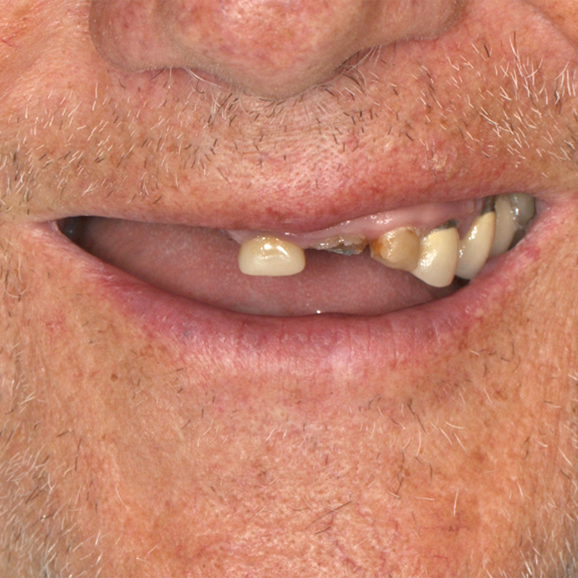 Full arch dental implants transformation - before