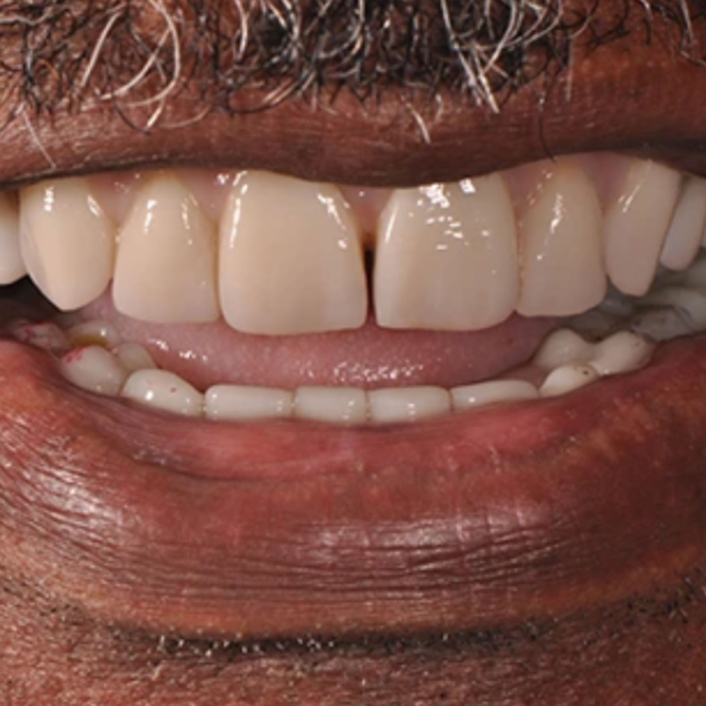 Full mouth dental implants transformation - after