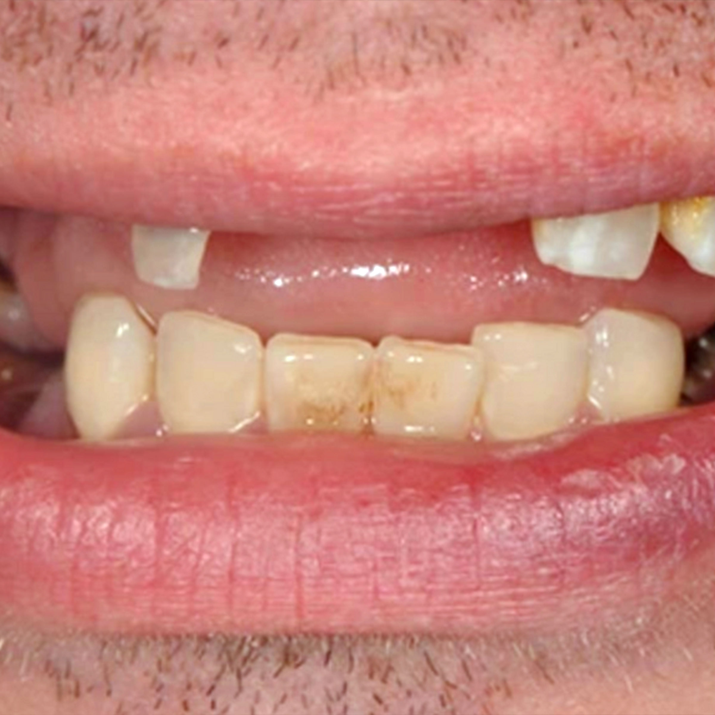 Full mouth dental implants transformation - before