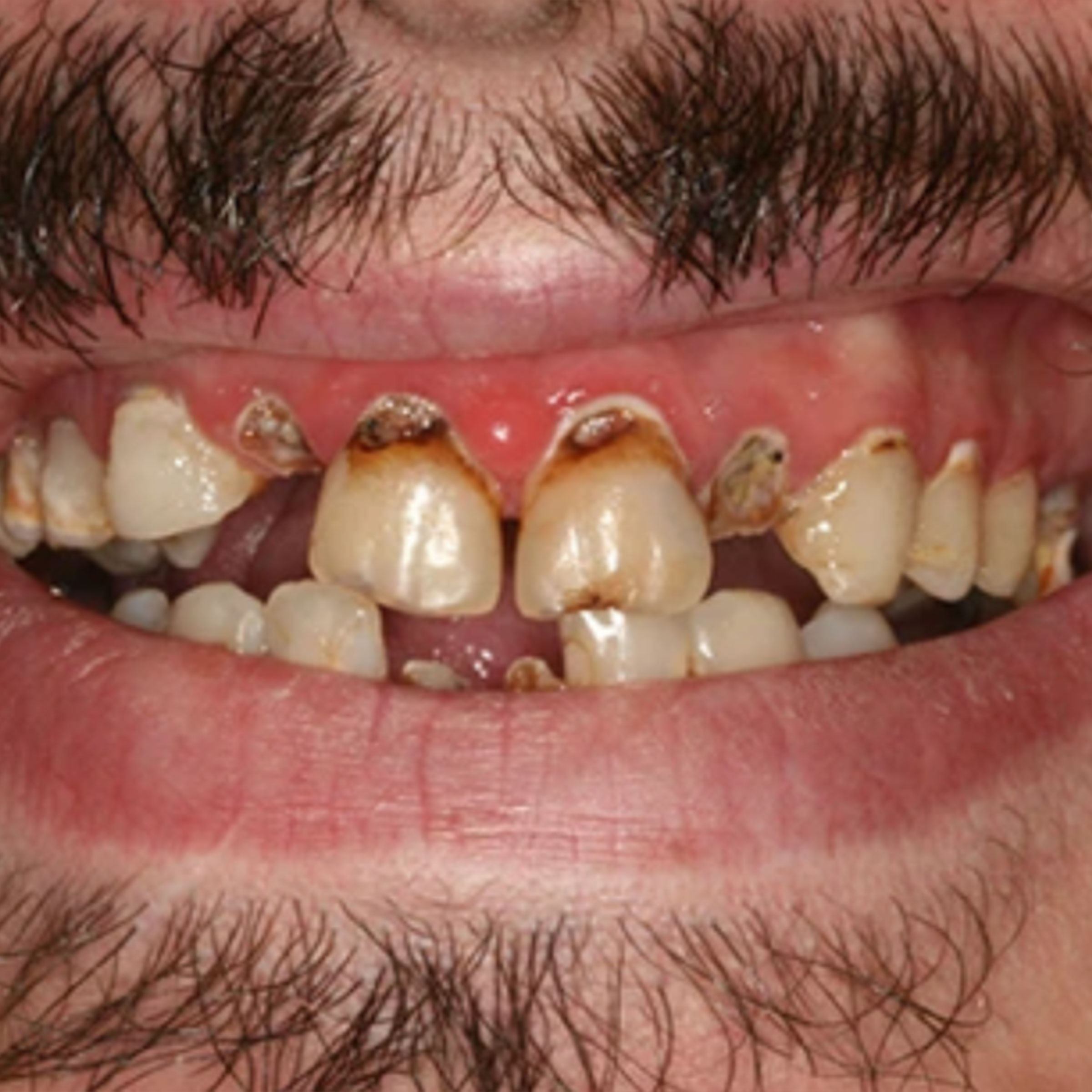 Full mouth dental implants transformation - before