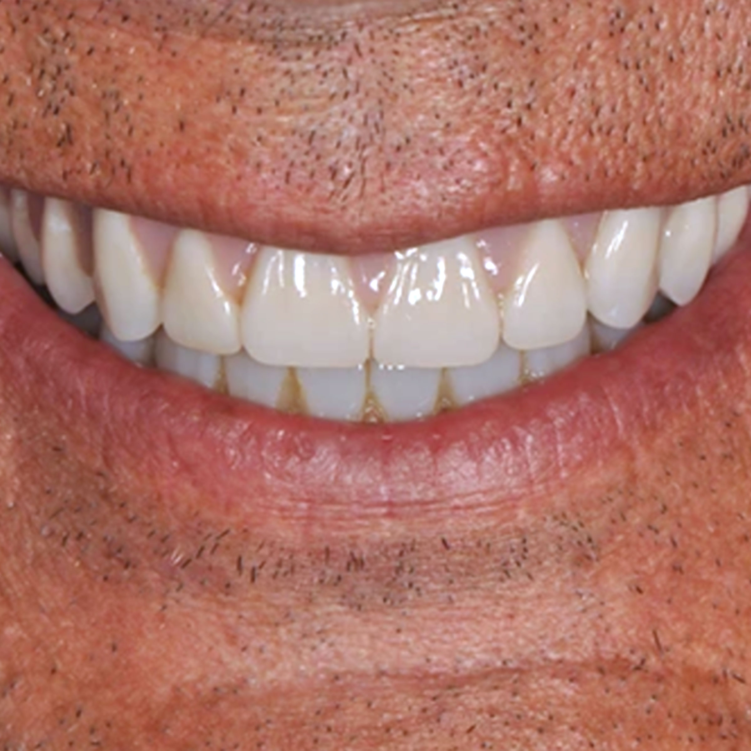Full mouth dental implants transformation - after