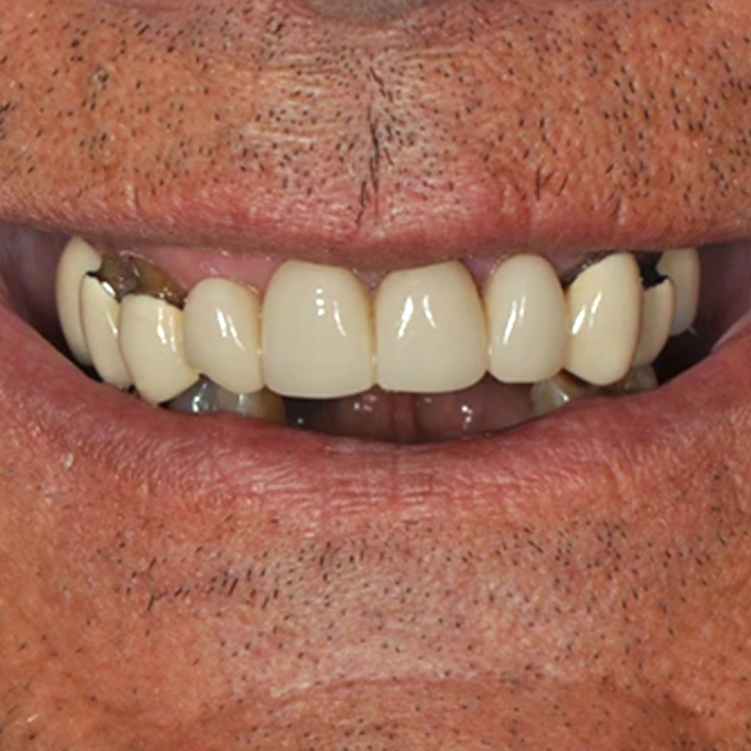 Full mouth dental implants transformation - before