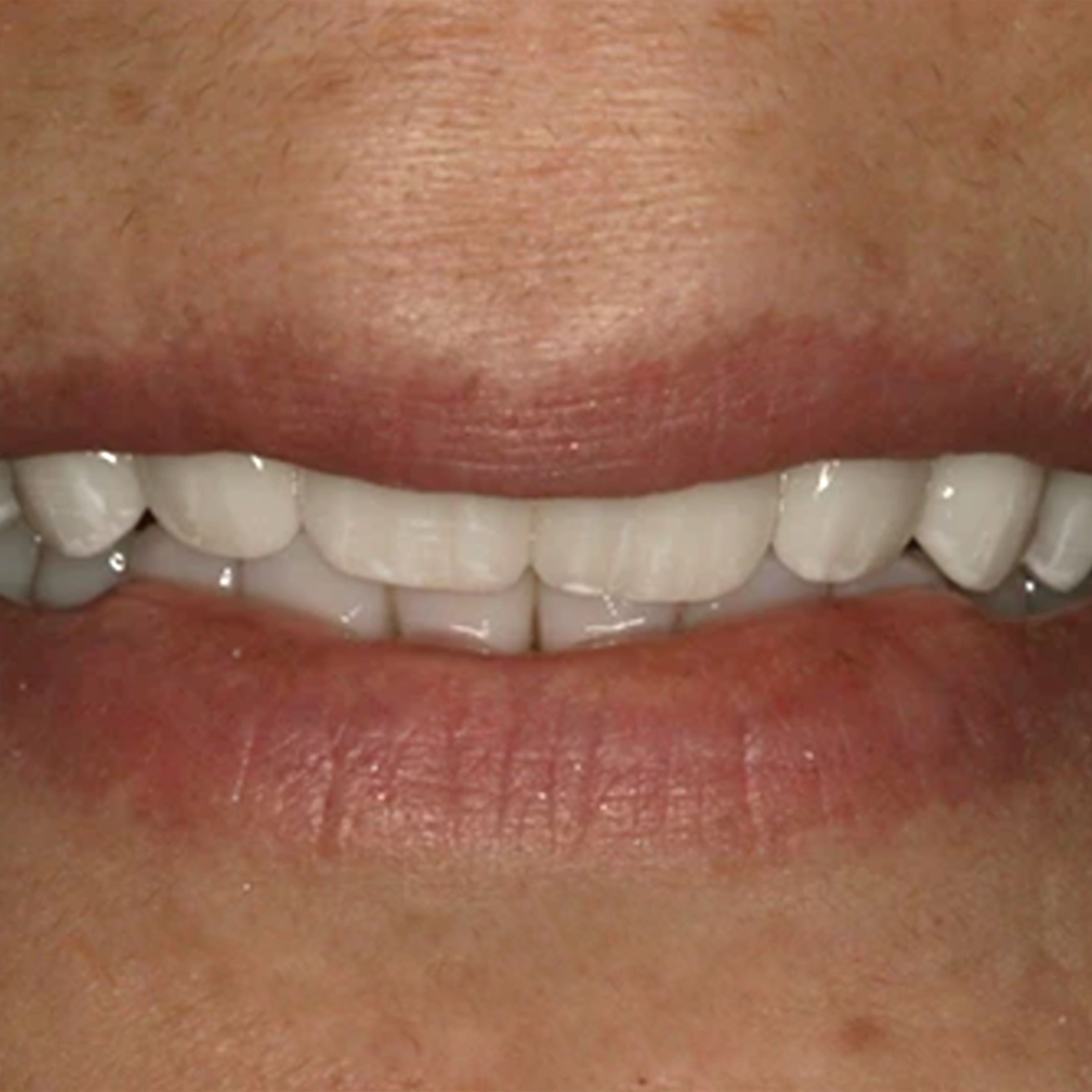Full mouth dental implants transformation - after