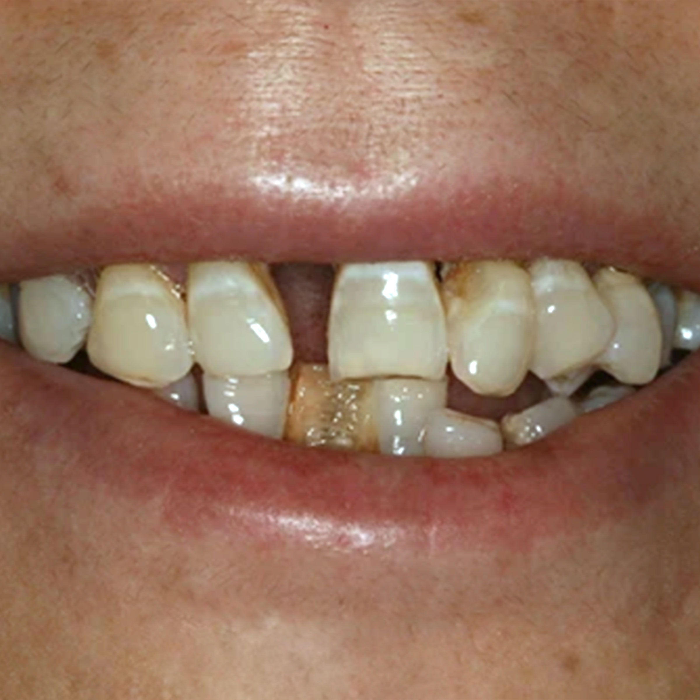 Full mouth dental implants transformation - before