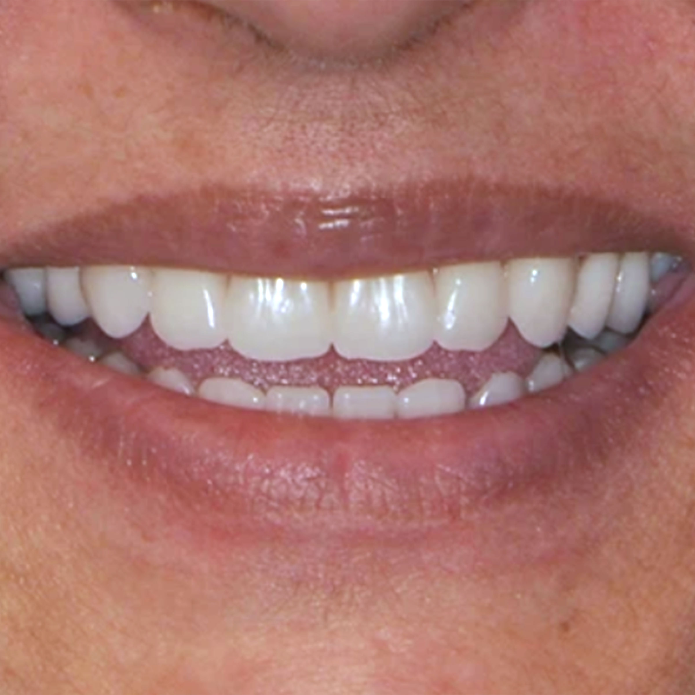 Full mouth dental implants transformation - after