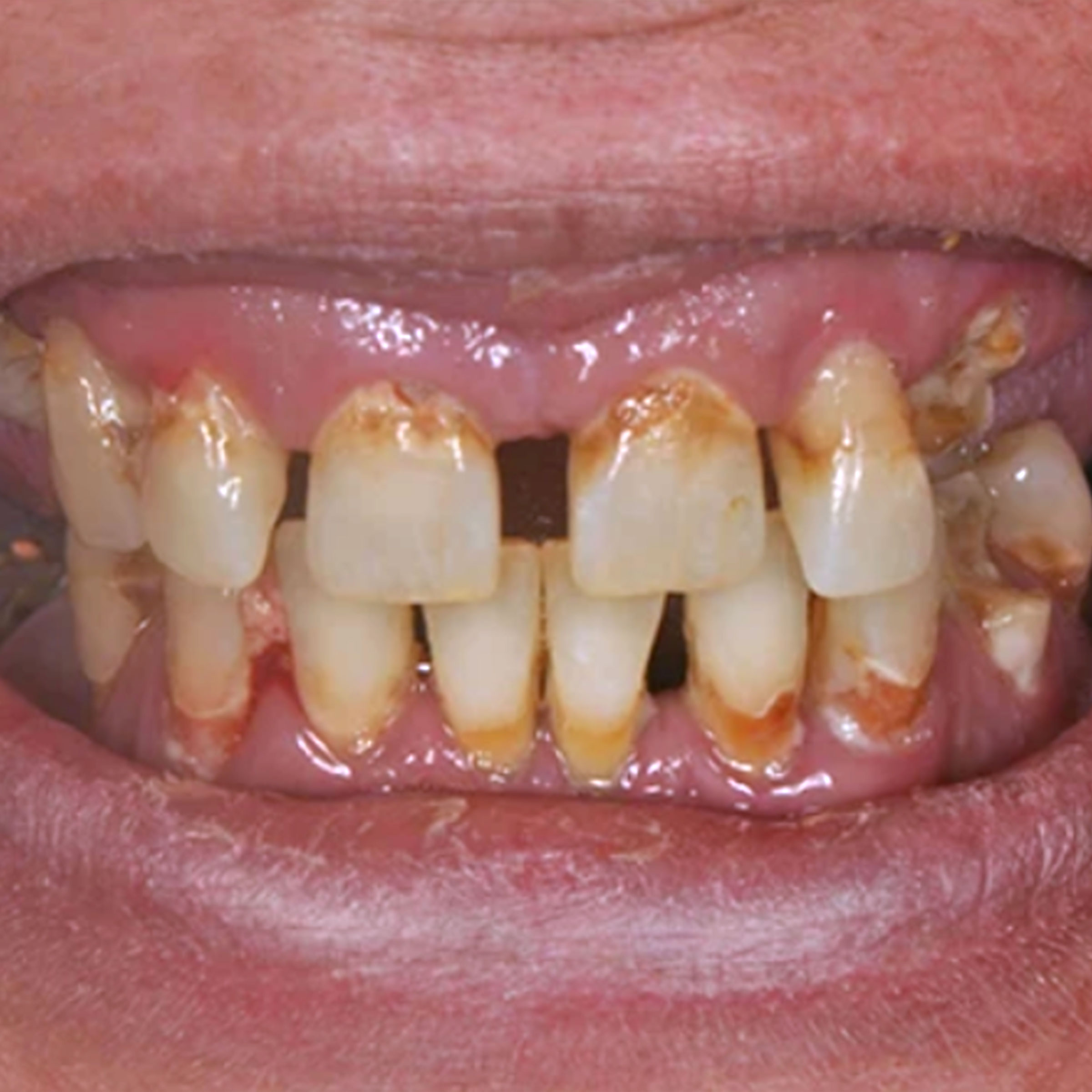 Full mouth dental implants transformation - before