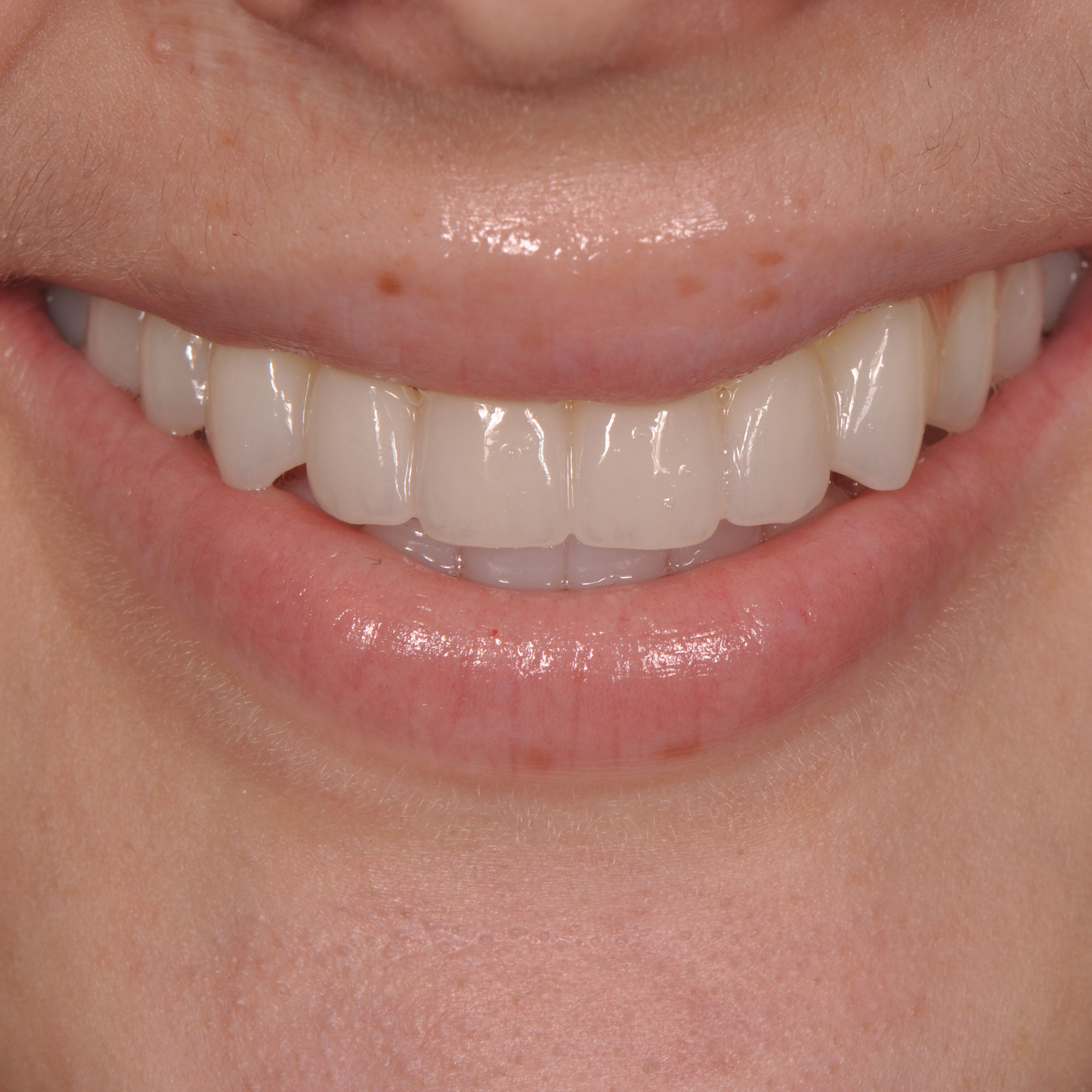 Full mouth dental implants transformation - after