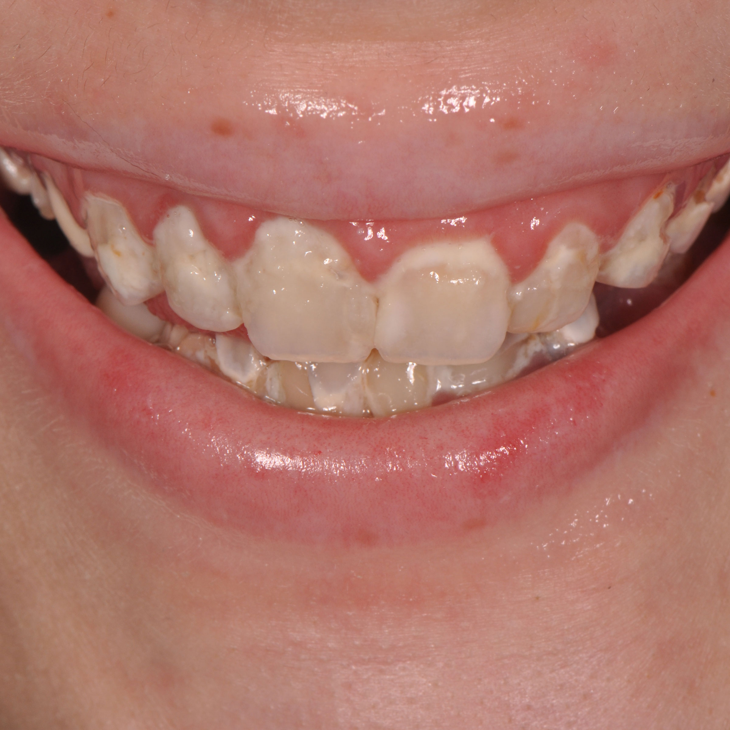 Full mouth dental implants transformation - before