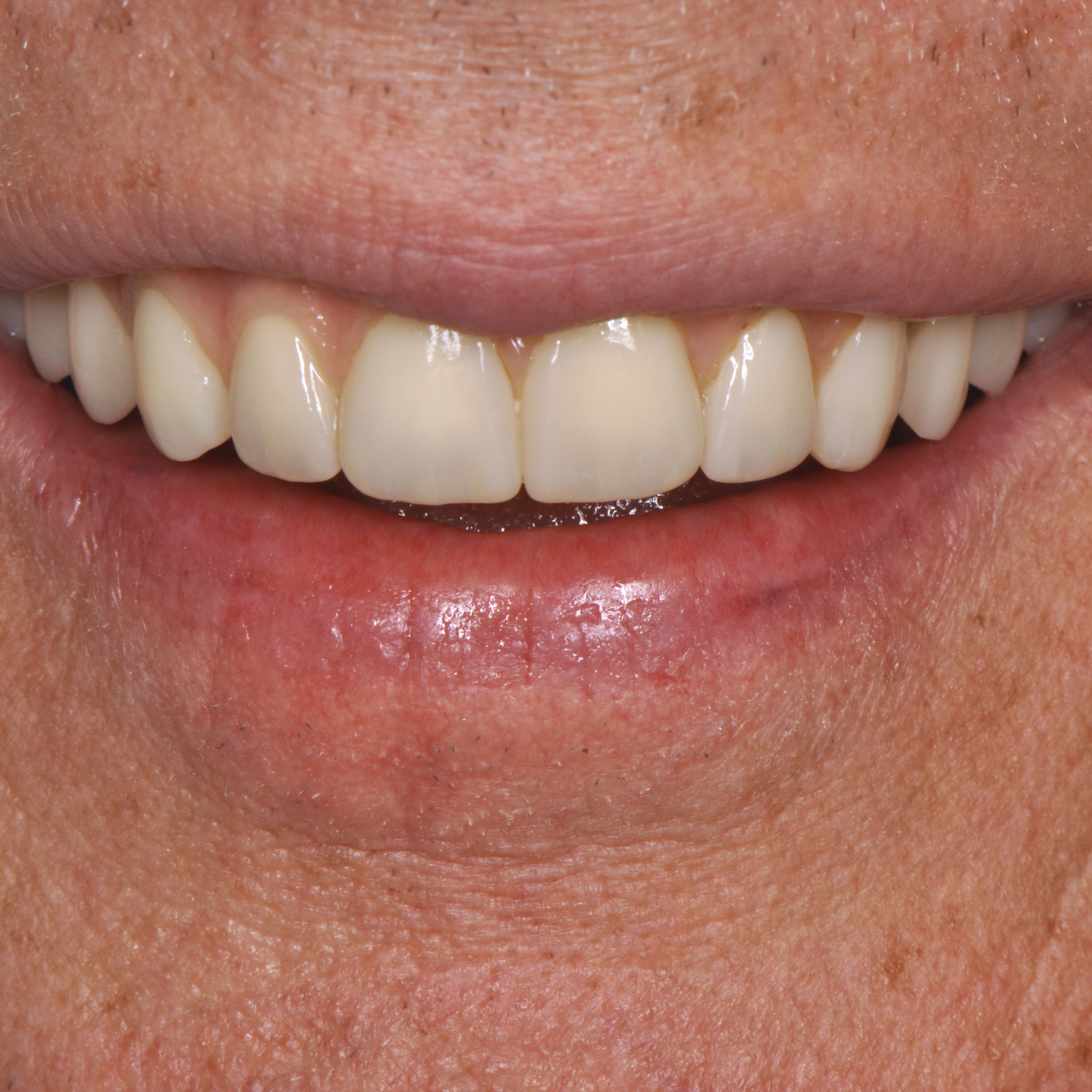 Full arch dental implants transformation - after