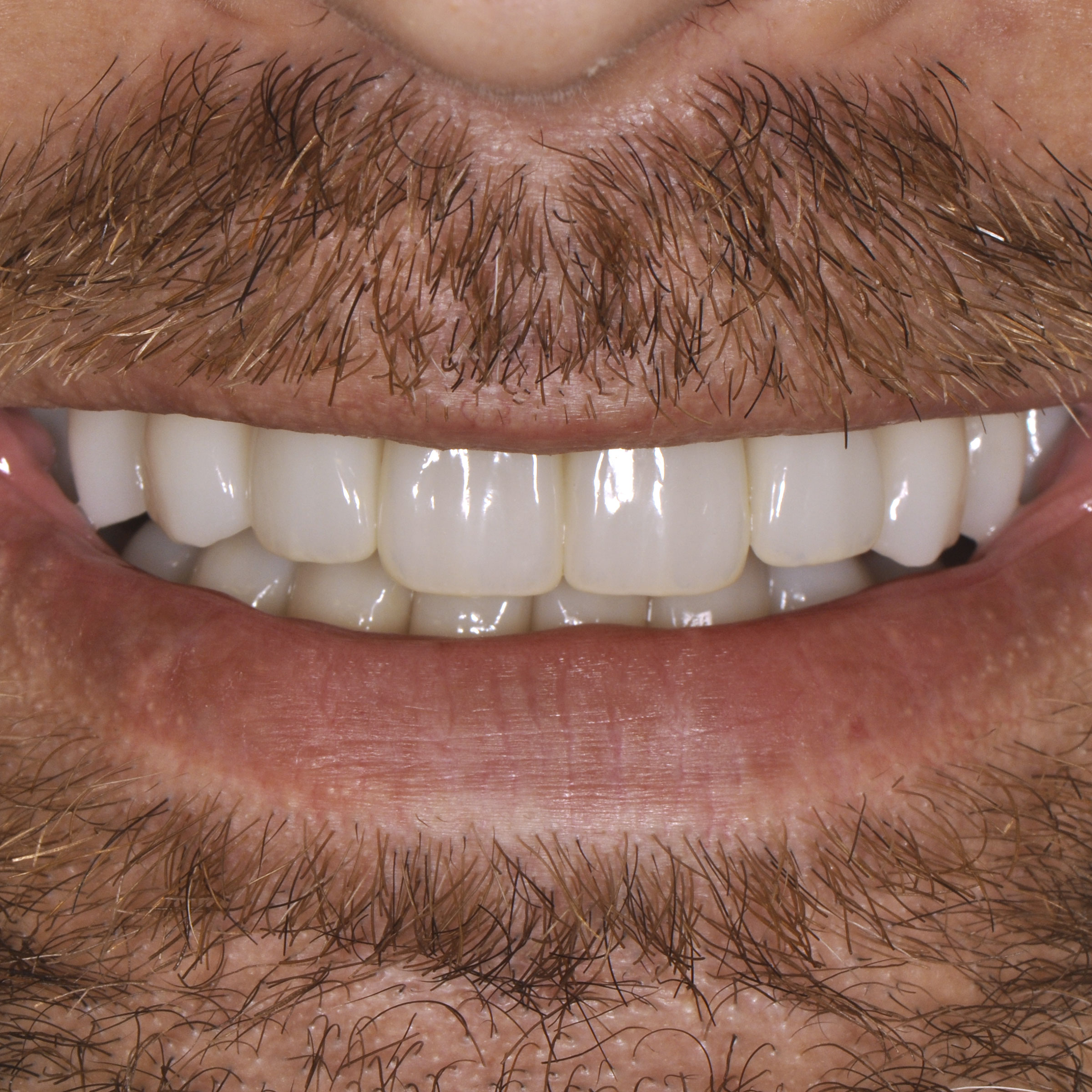 Full mouth dental implants transformation - after