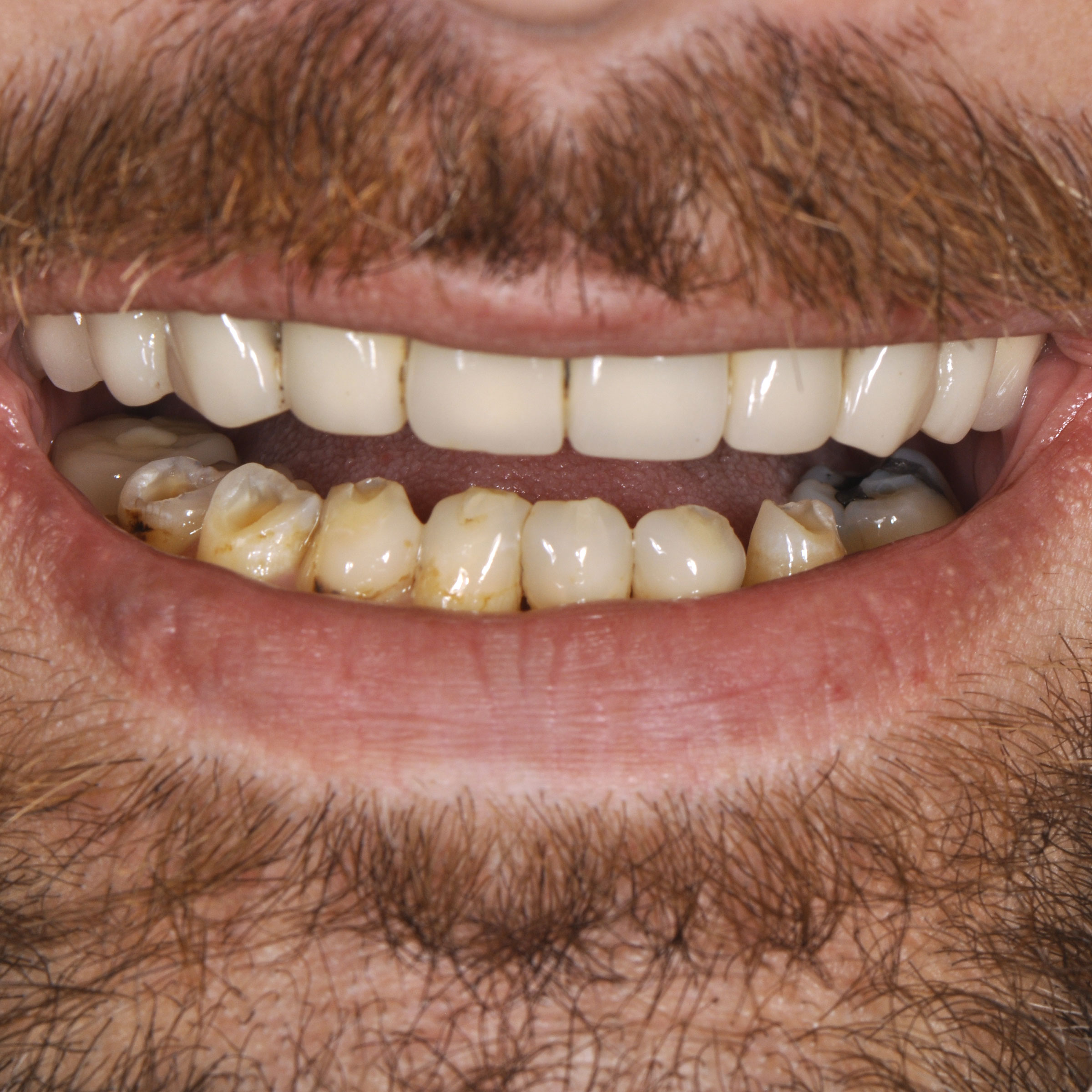 Full mouth dental implants transformation - before