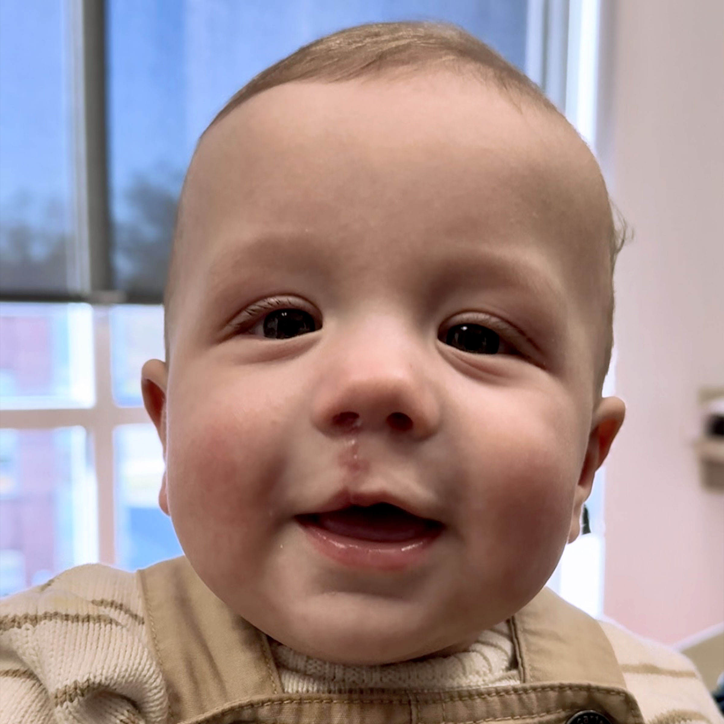 Cleft & Craniofacial Patient Transformation - After