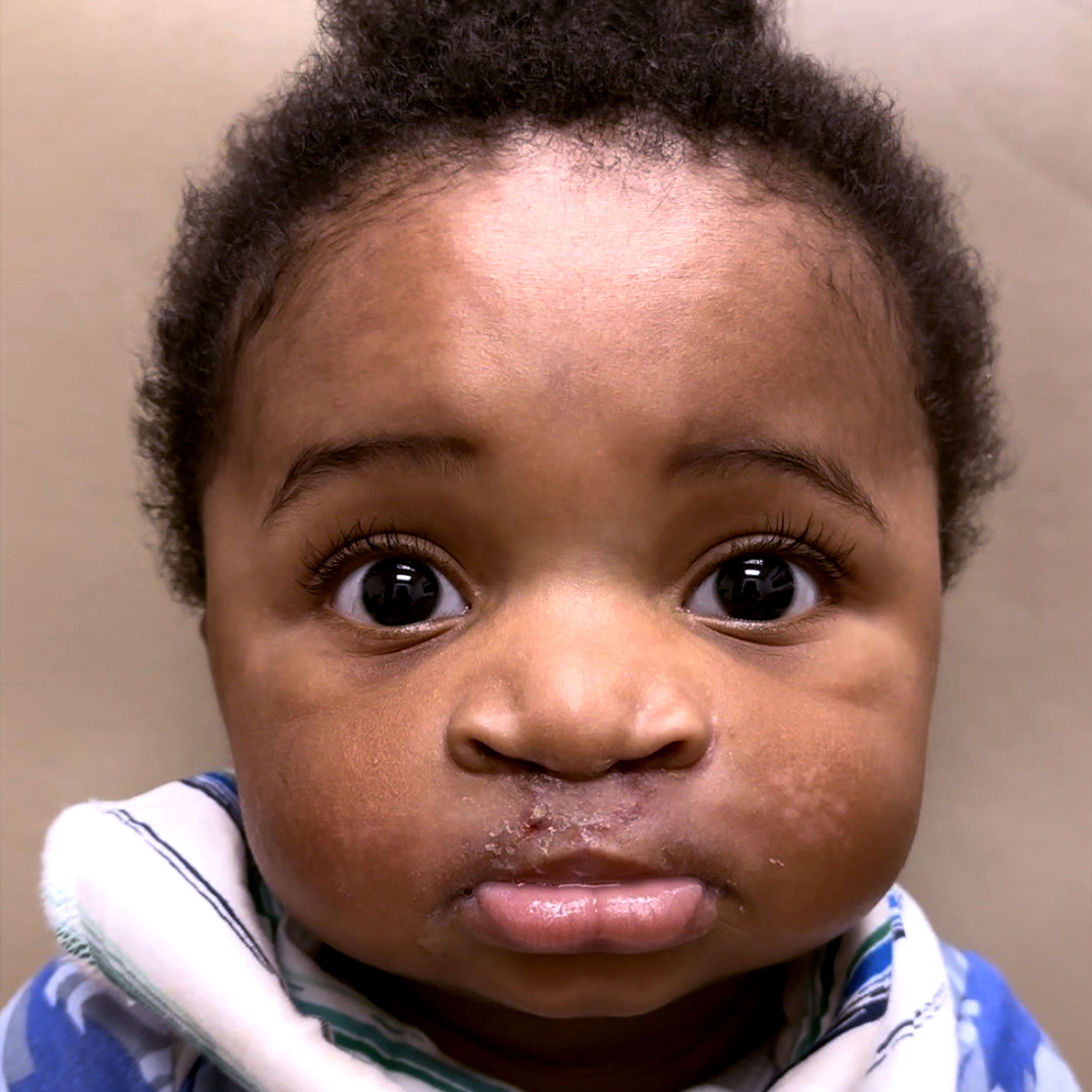 Cleft & Craniofacial Patient Transformation - After
