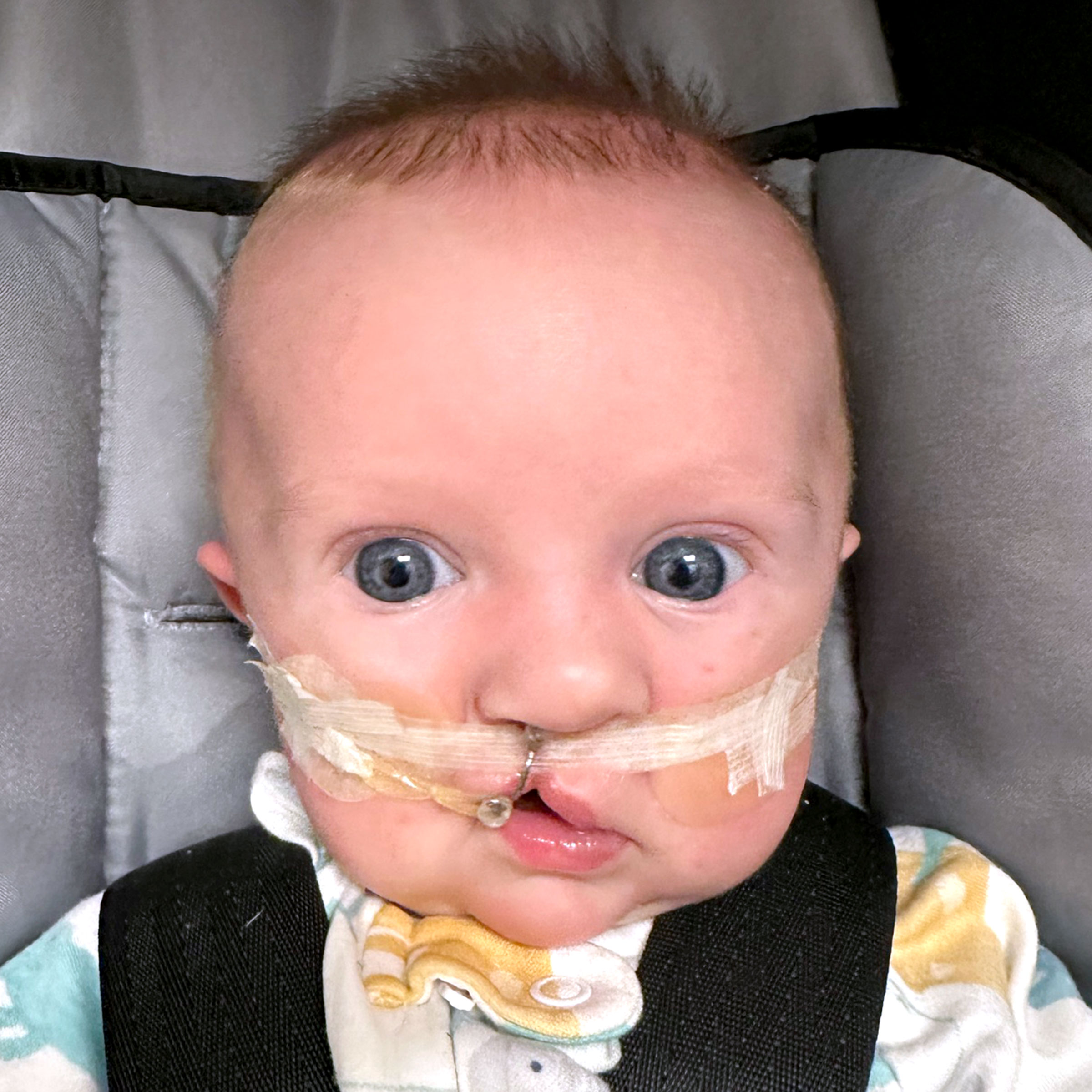 Cleft & Craniofacial Patient Transformation - Before