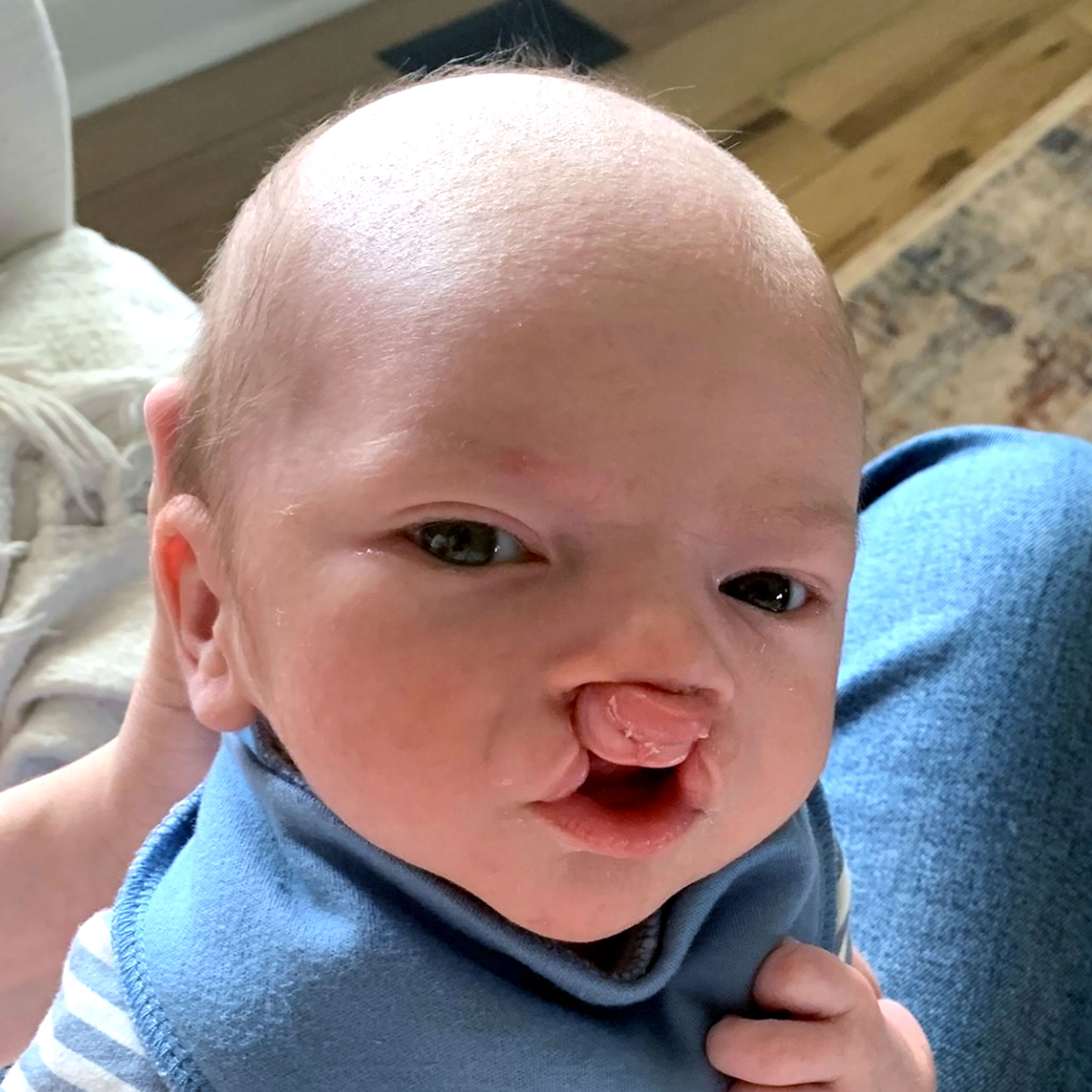 Cleft & Craniofacial Patient Transformation - Before